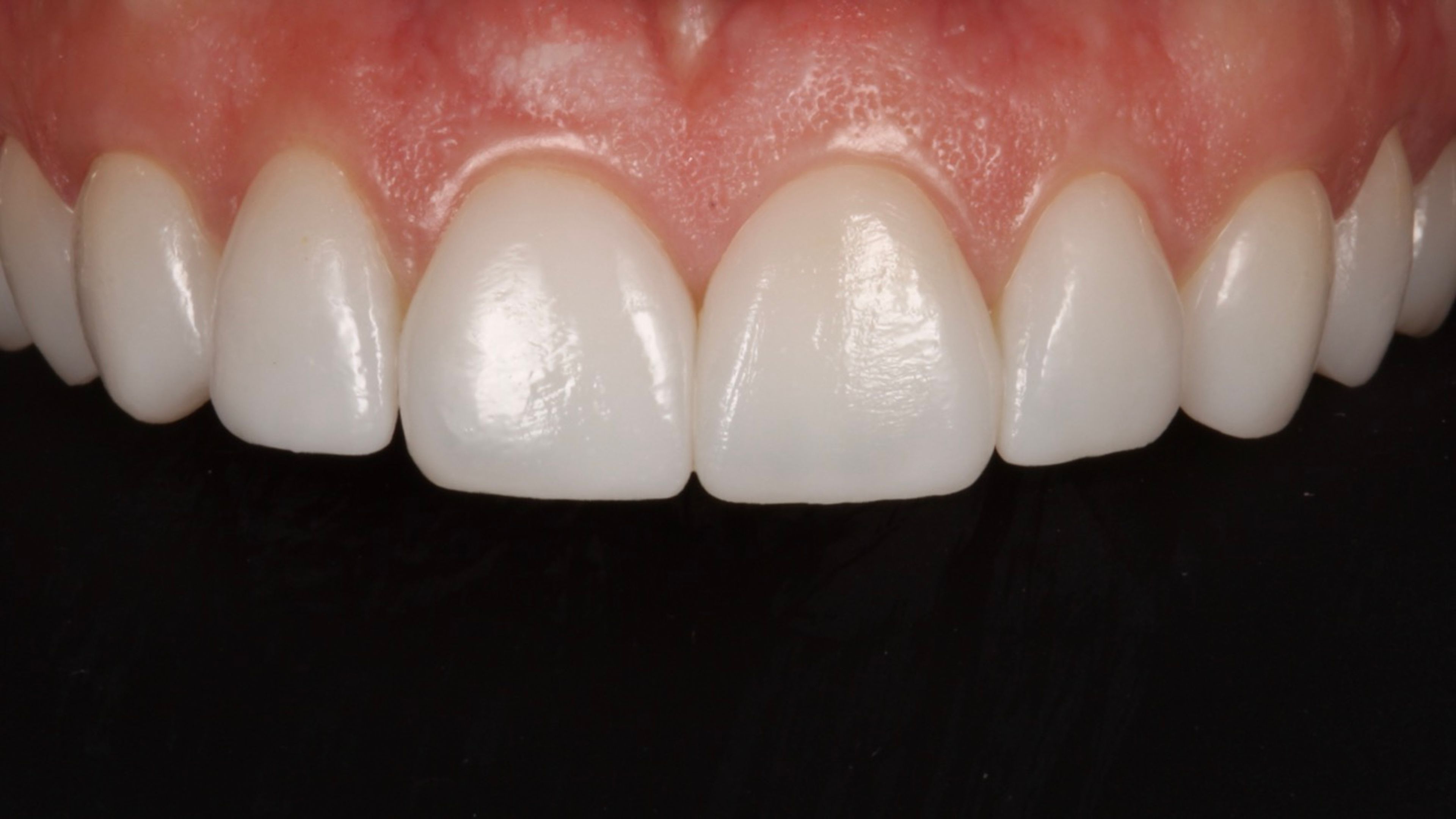 The same smile makeover case photographed five years after placement — porcelain margins still seamless, gum tissue still healthy
