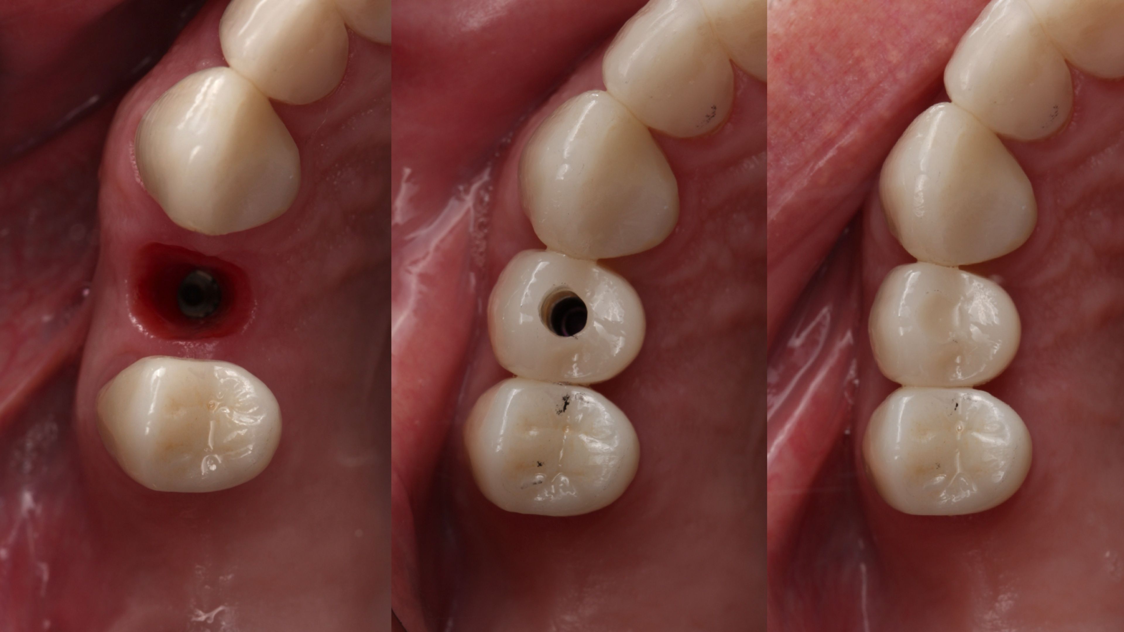 Dental implant treatment sequence showing placement and restoration