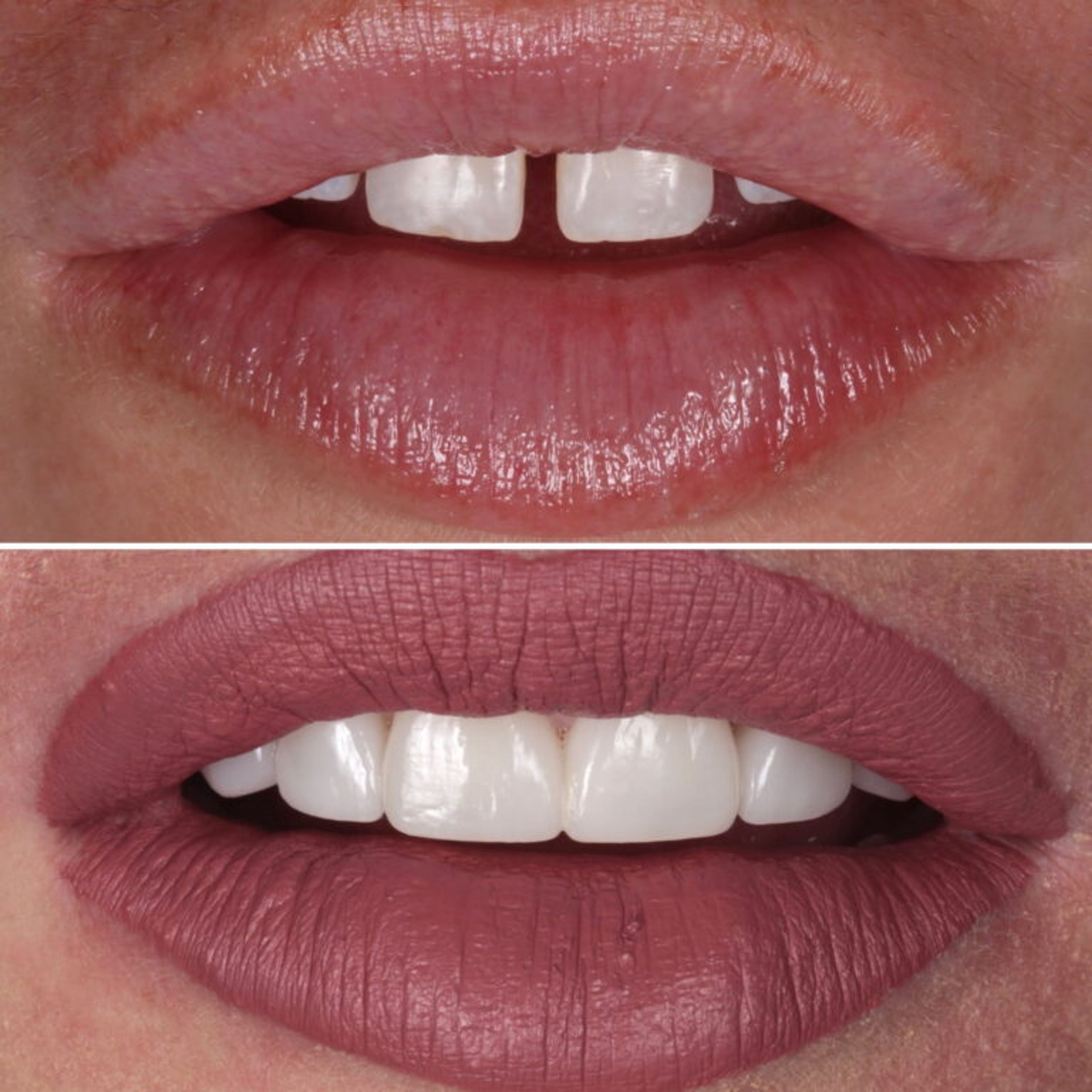 Porcelain Veneers — Smile Makeover before and after - porcelain veneers Vancouver - Transcend Dentistry