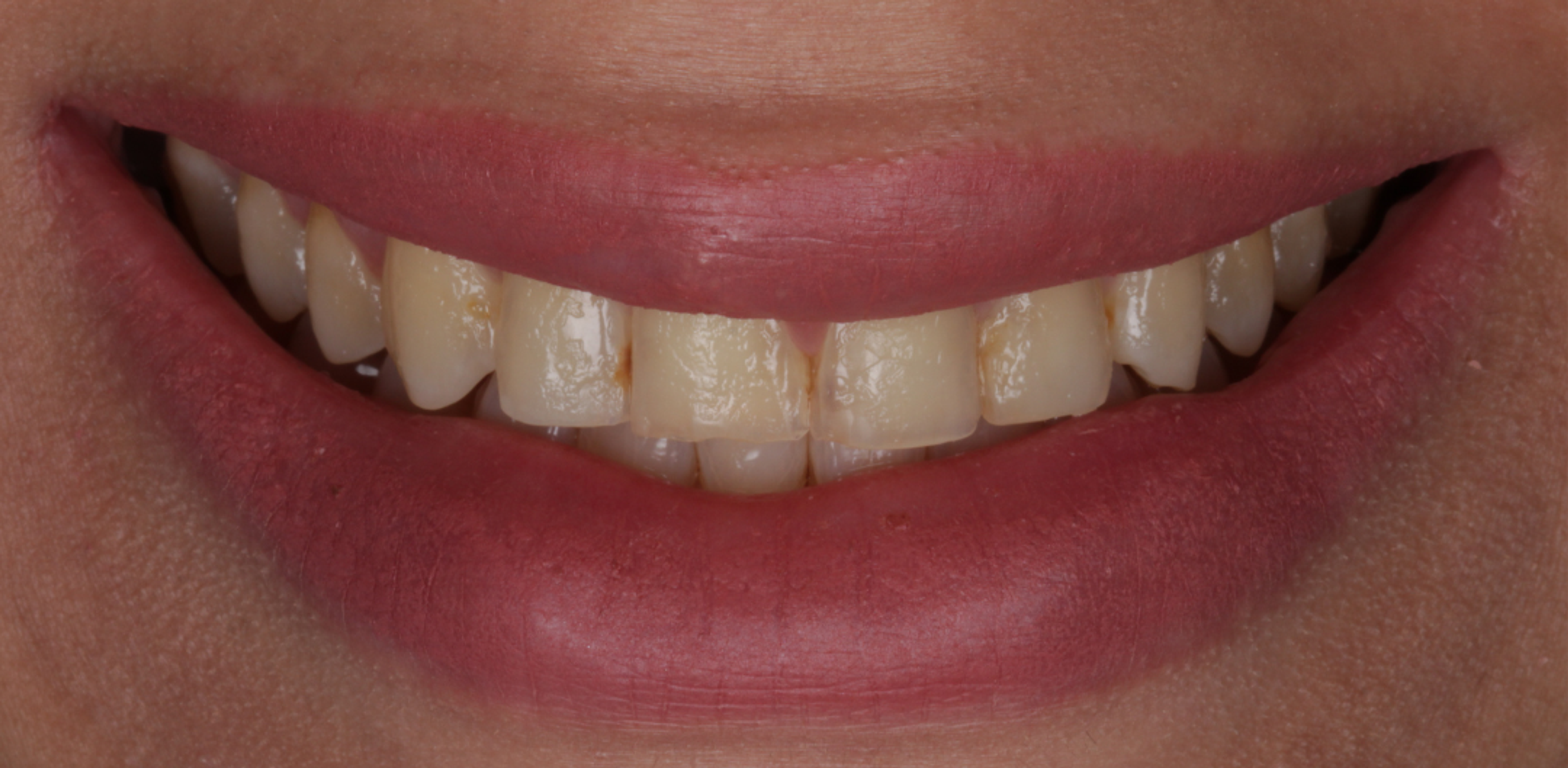 A smile before treatment at Transcend Specialized Dentistry — yellowed, worn and uneven upper teeth visible within the smile