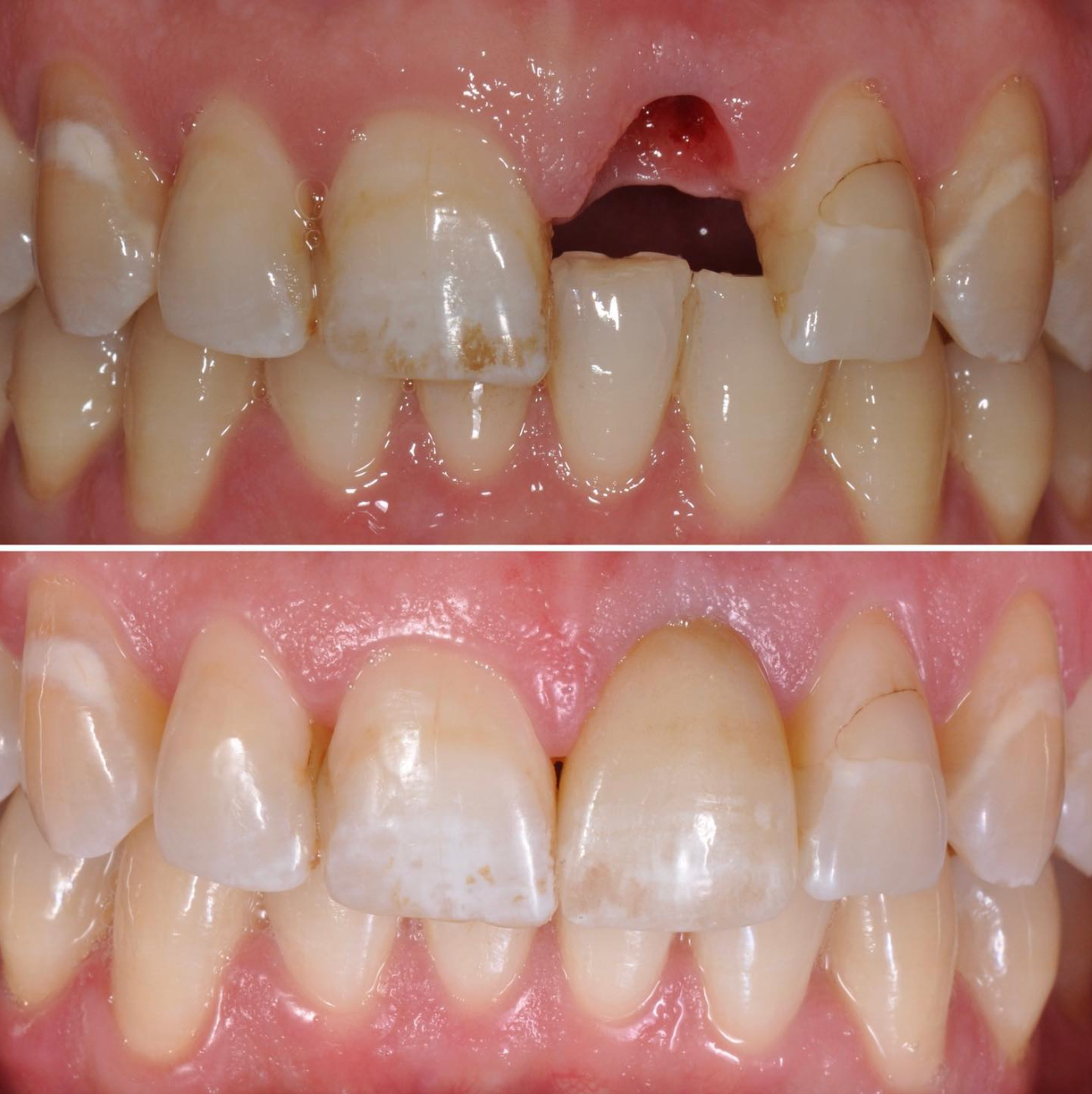 Single Tooth Implant before and after - dental implants Vancouver - Transcend Dentistry