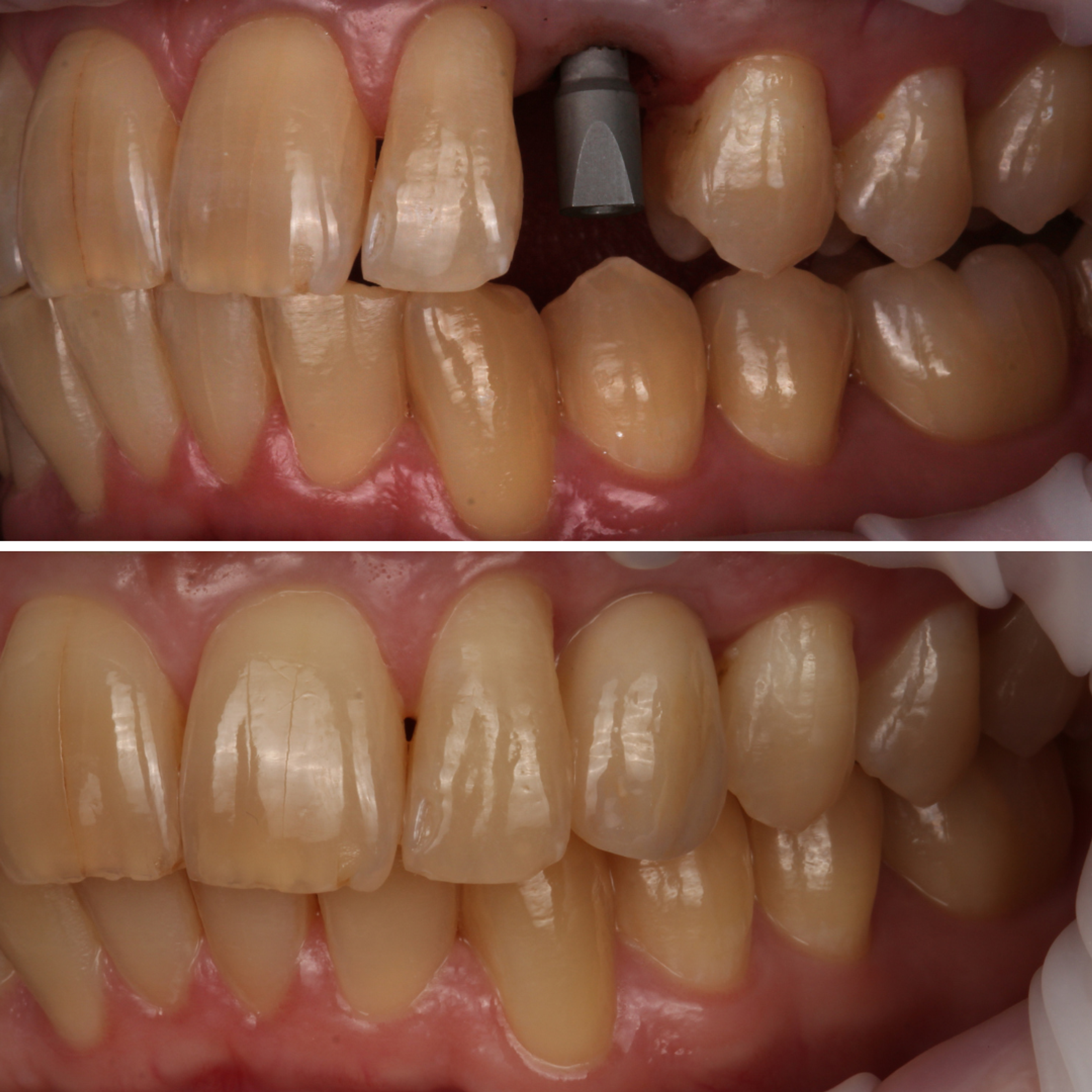 Single Implant — Lateral — before and after
