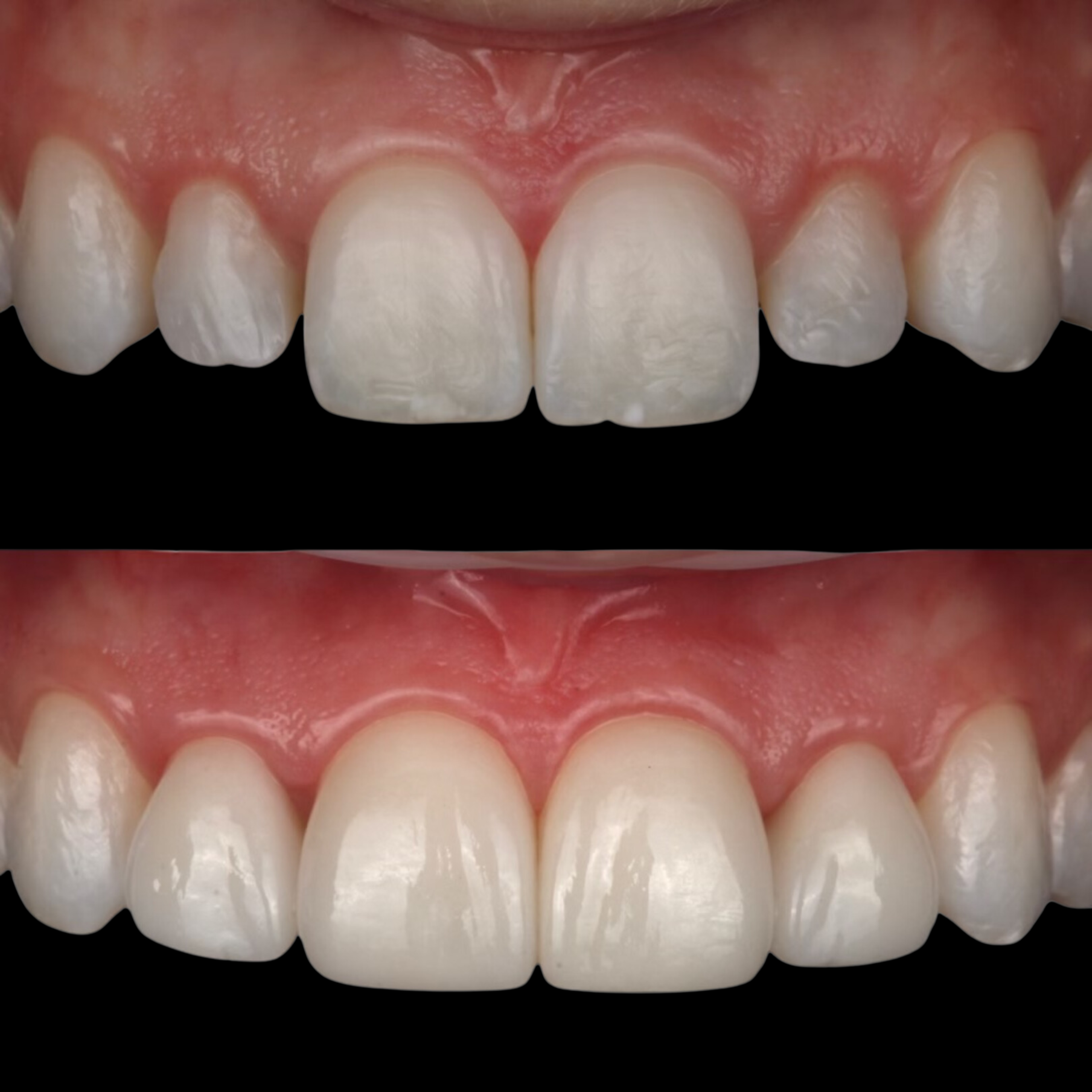 Anterior Restoration — before and after