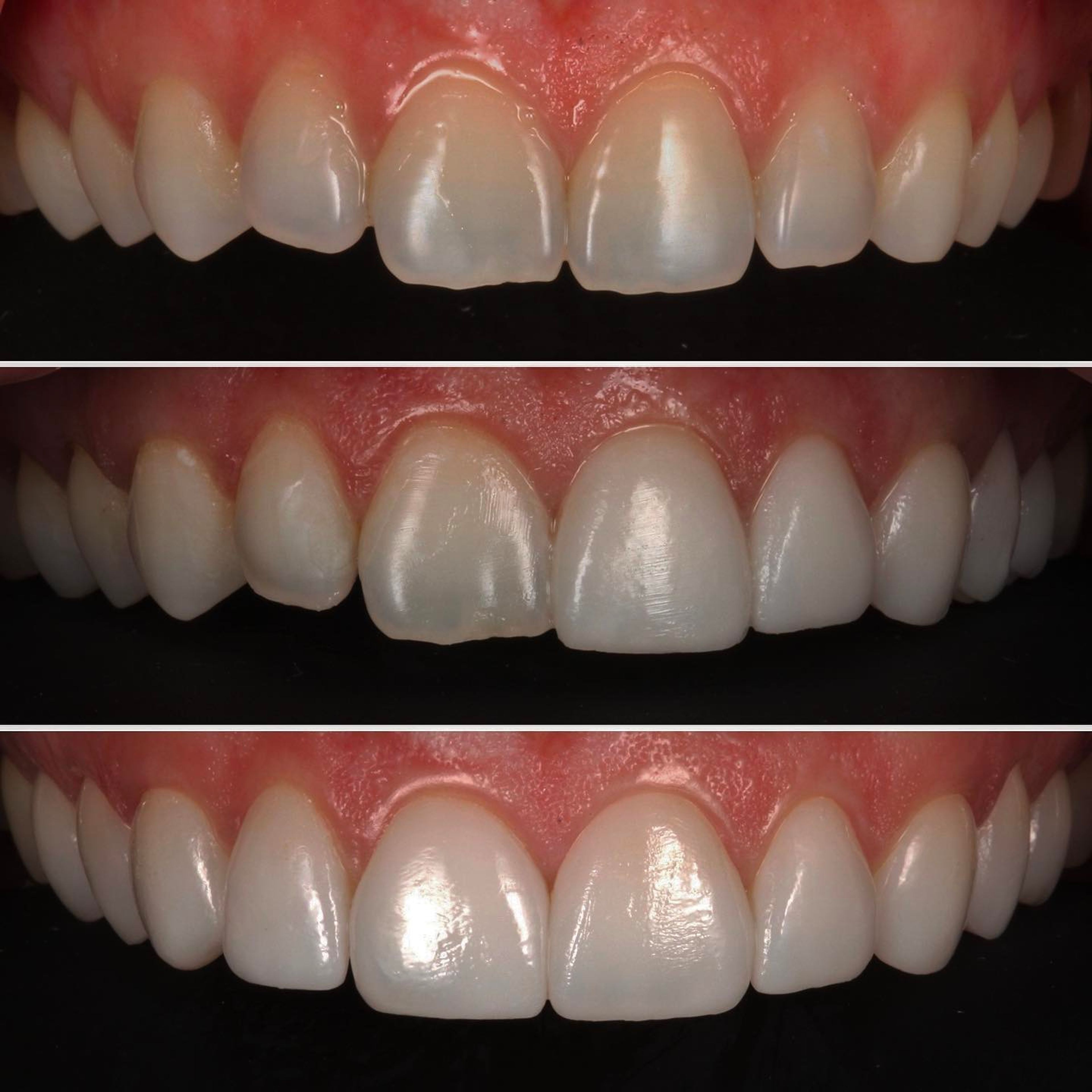 Three-stage progression of a no-prep porcelain veneer case at Transcend Specialized Dentistry — before treatment, the try-in moment, and the final bonded result