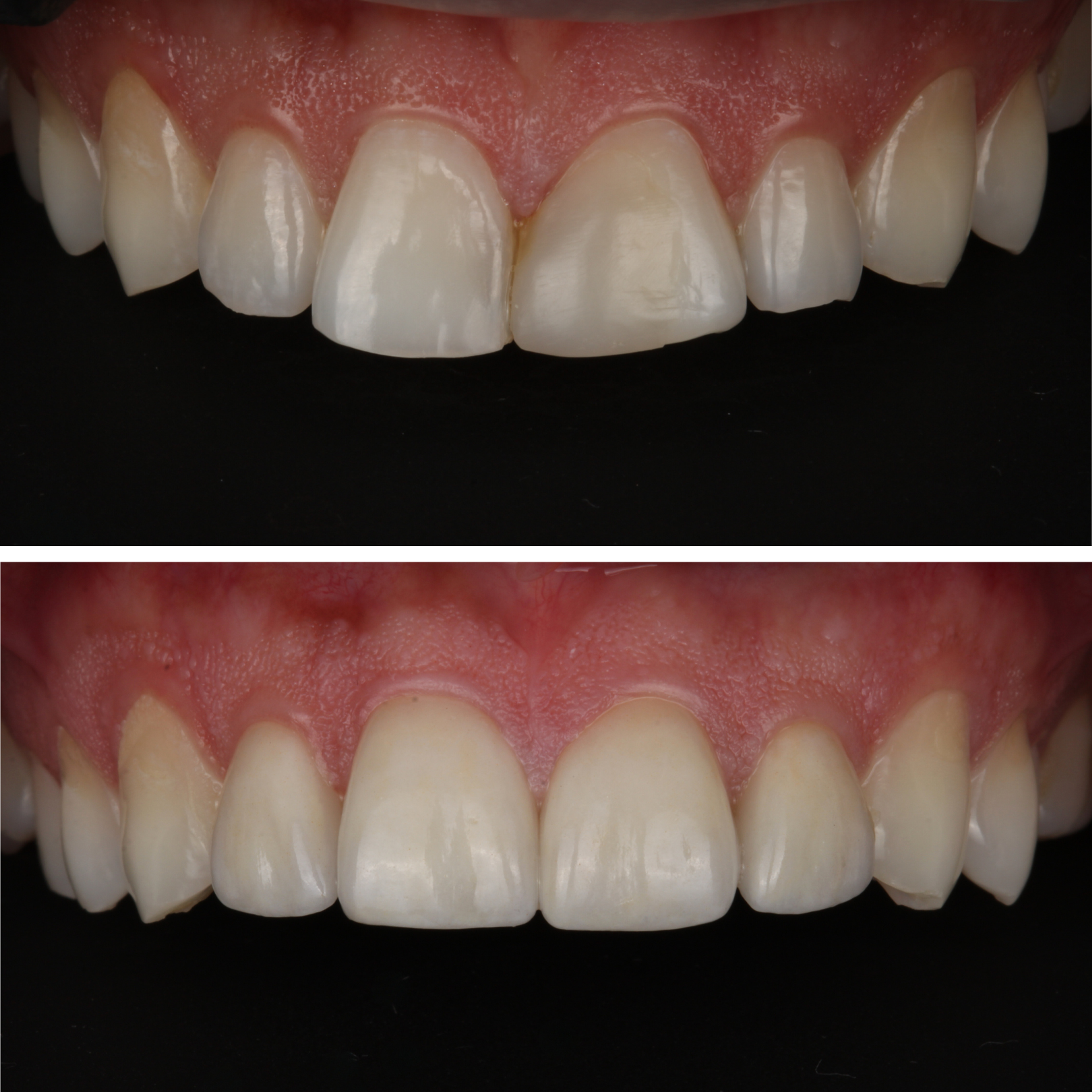 Anterior Veneers — Dramatic Repair before and after - cosmetic dentistry Vancouver - Transcend Dentistry