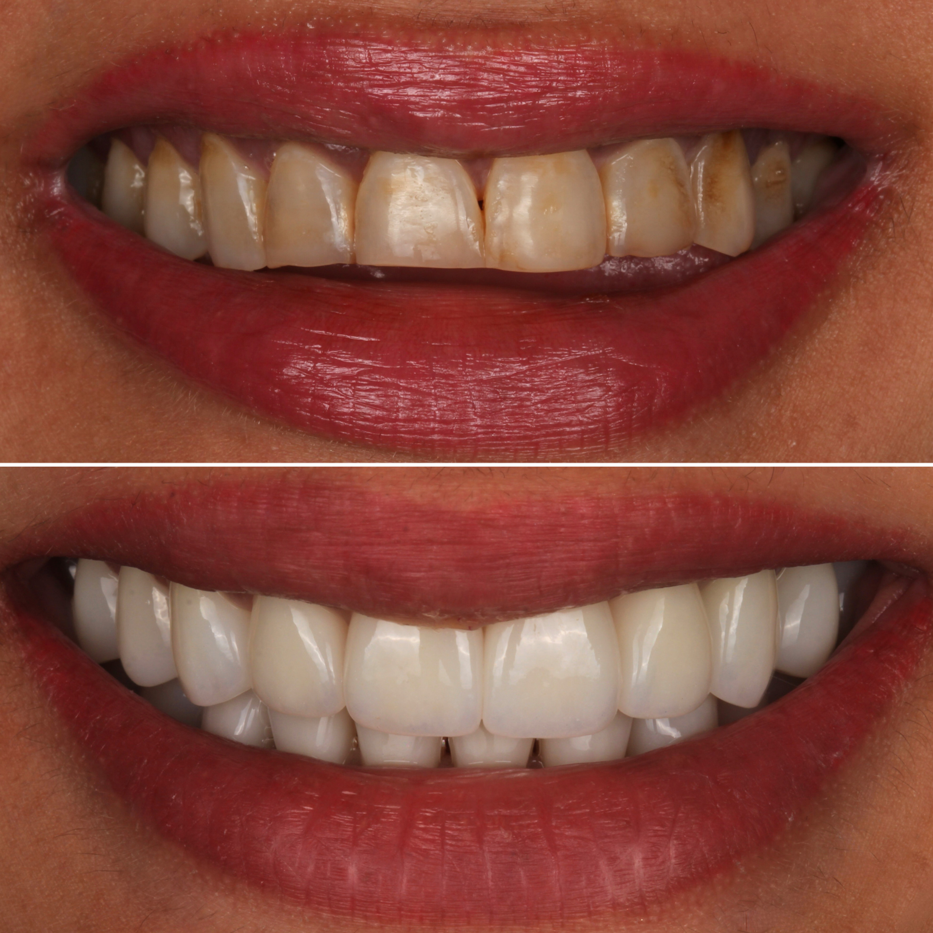 Smile makeover with porcelain veneers — before and after