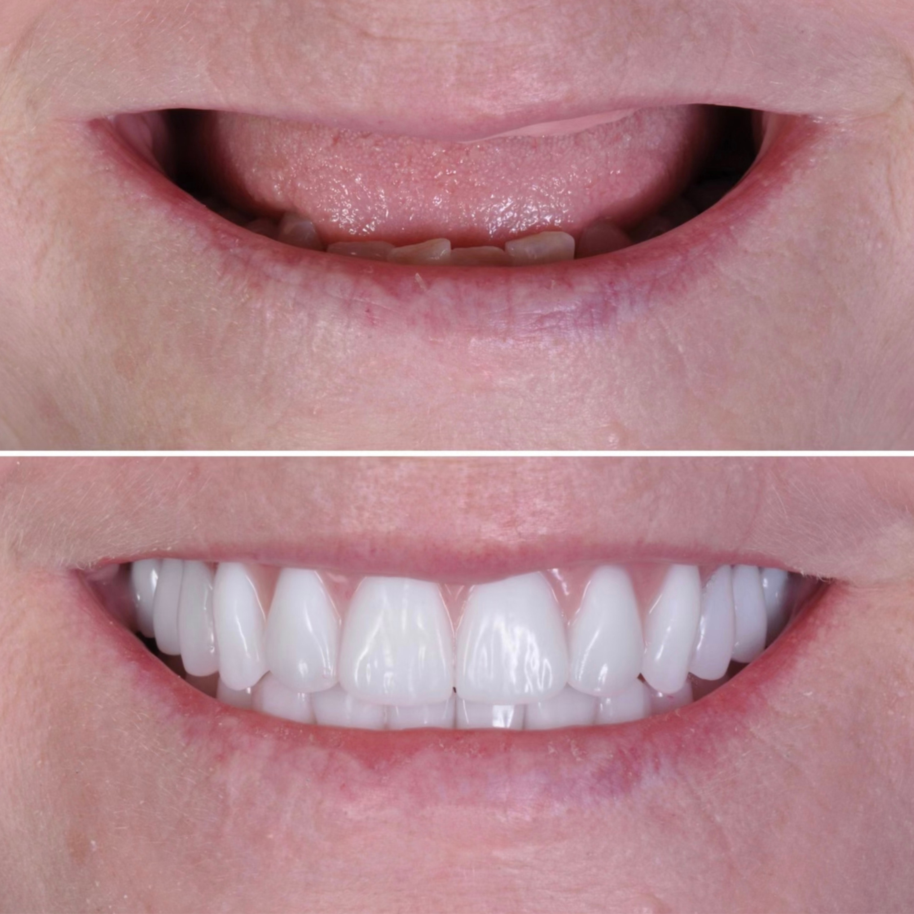 Complete smile transformation with dentures — before and after