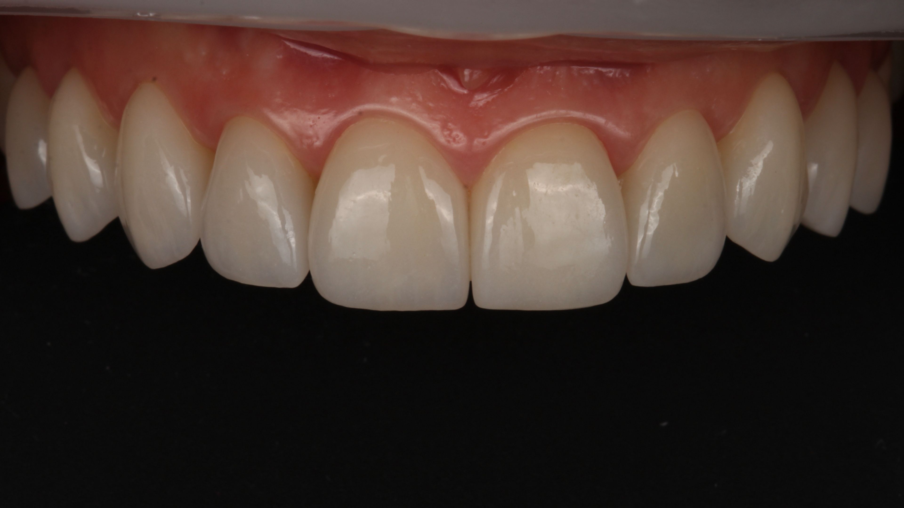 Final result: porcelain veneers bonded to teeth that started worn and short, restoring length and proportion