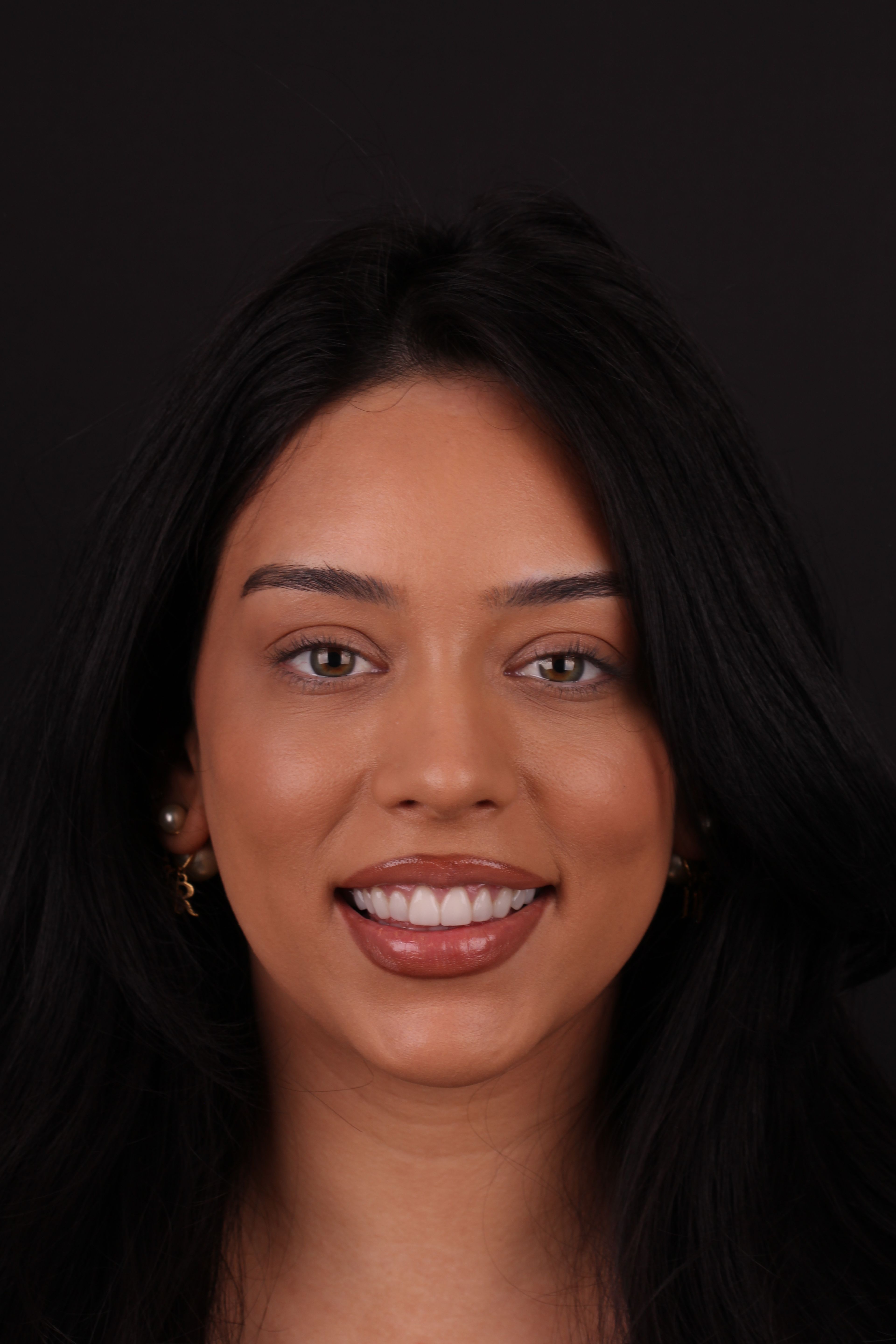 Porcelain veneers patient smiling — real result by a prosthodontist at Transcend Dentistry Vancouver