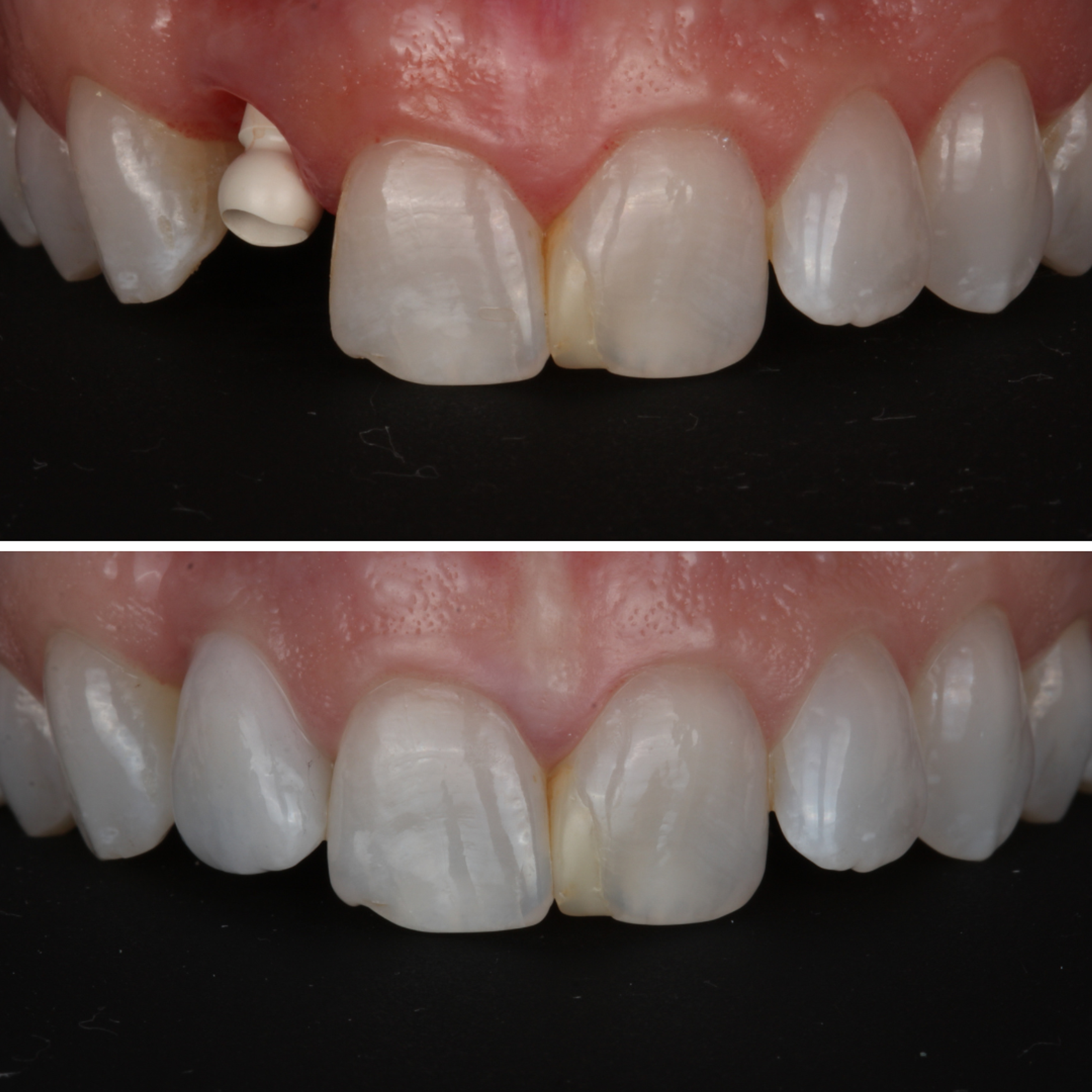Single Implant — Fractured Tooth — before and after