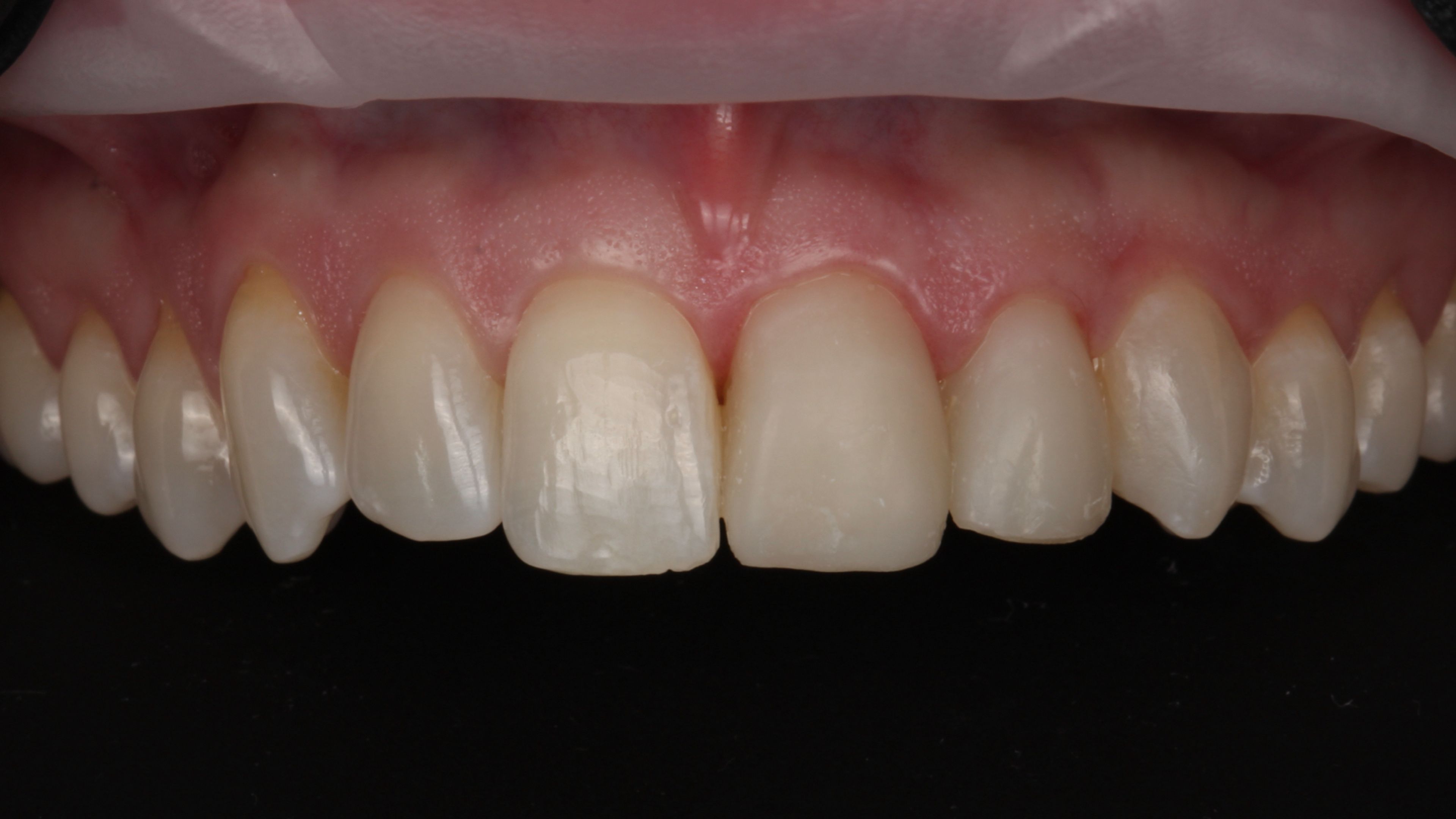 Provisional temporaries placed on the same teeth — approximating the new shape, shade, and proportions while the final porcelain is being crafted in the lab
