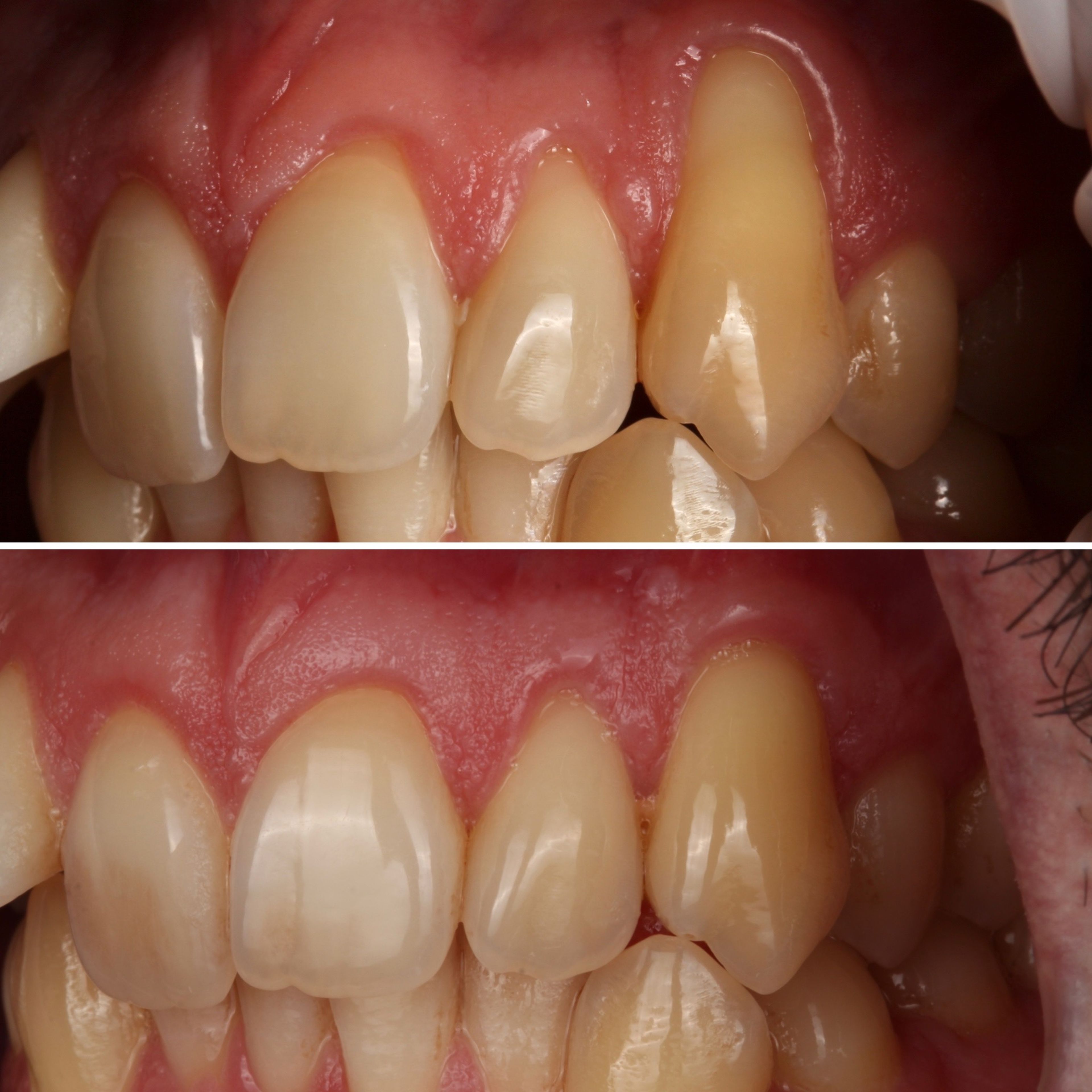 Gum grafting for recession — before and after