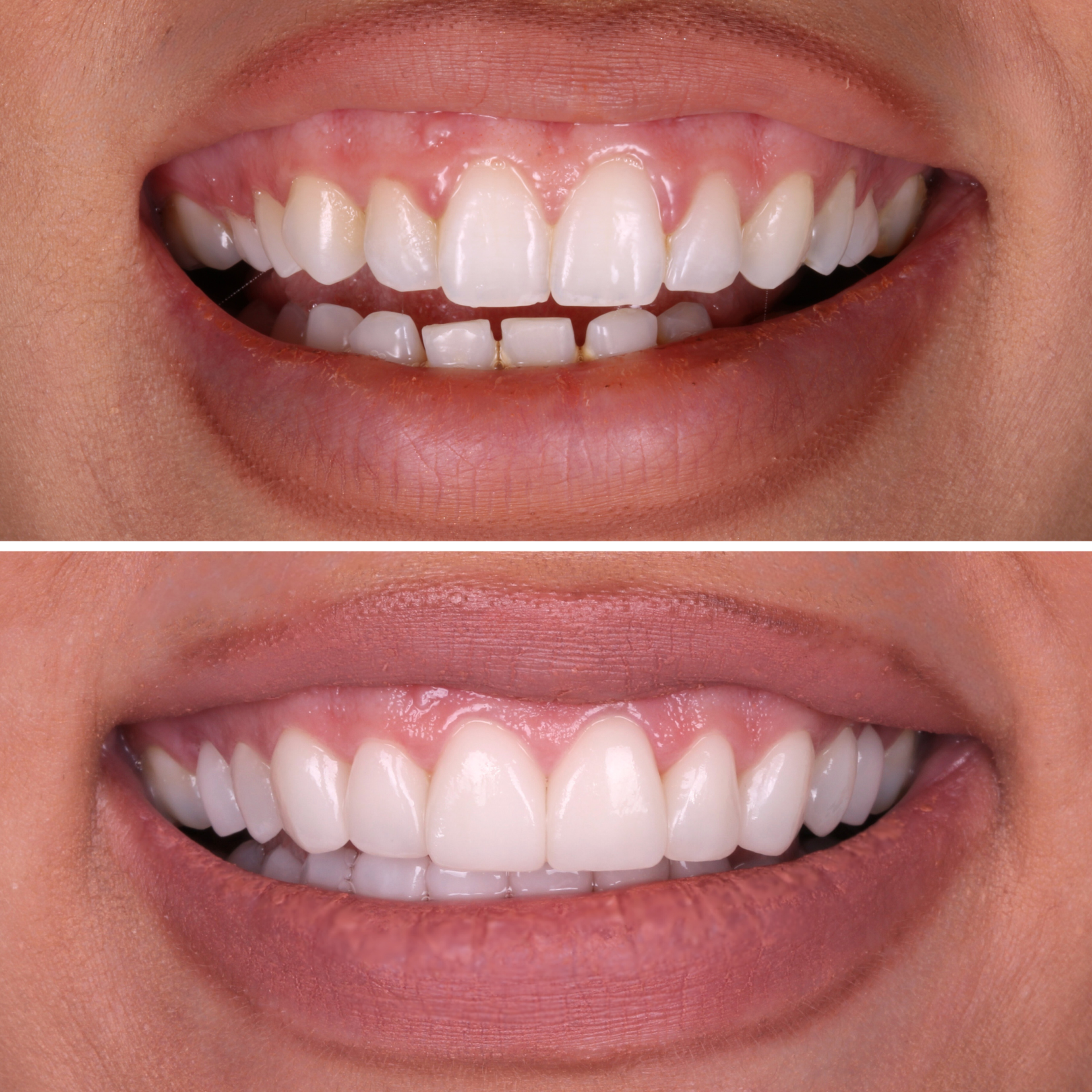 Gummy Smile Treatment before and after — specialist dental care at Transcend Dentistry Vancouver
