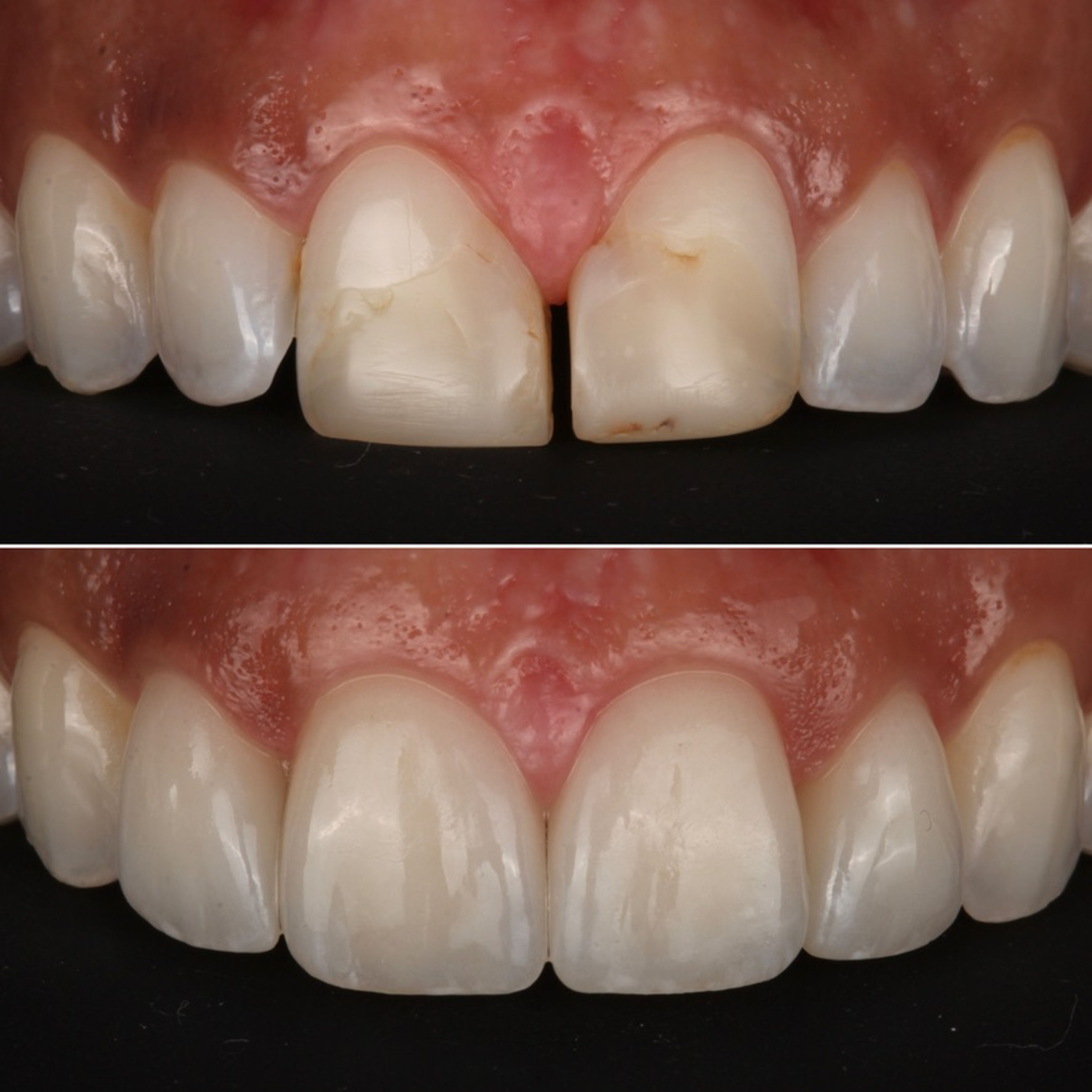 Dental Crowns & Bridges before and after — specialist dental care at Transcend Dentistry Vancouver