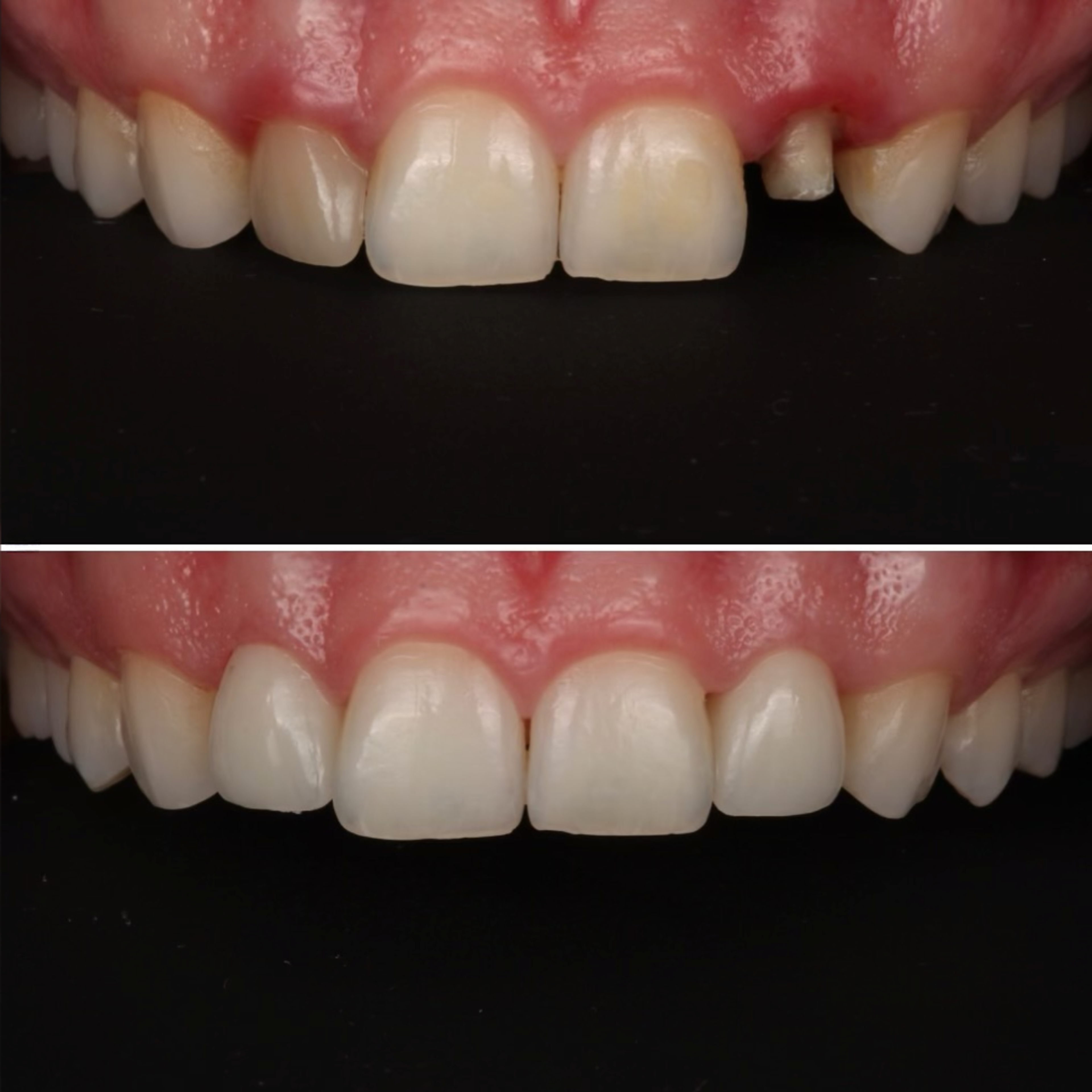 Anterior Restoration — Chipped to Smooth — before and after