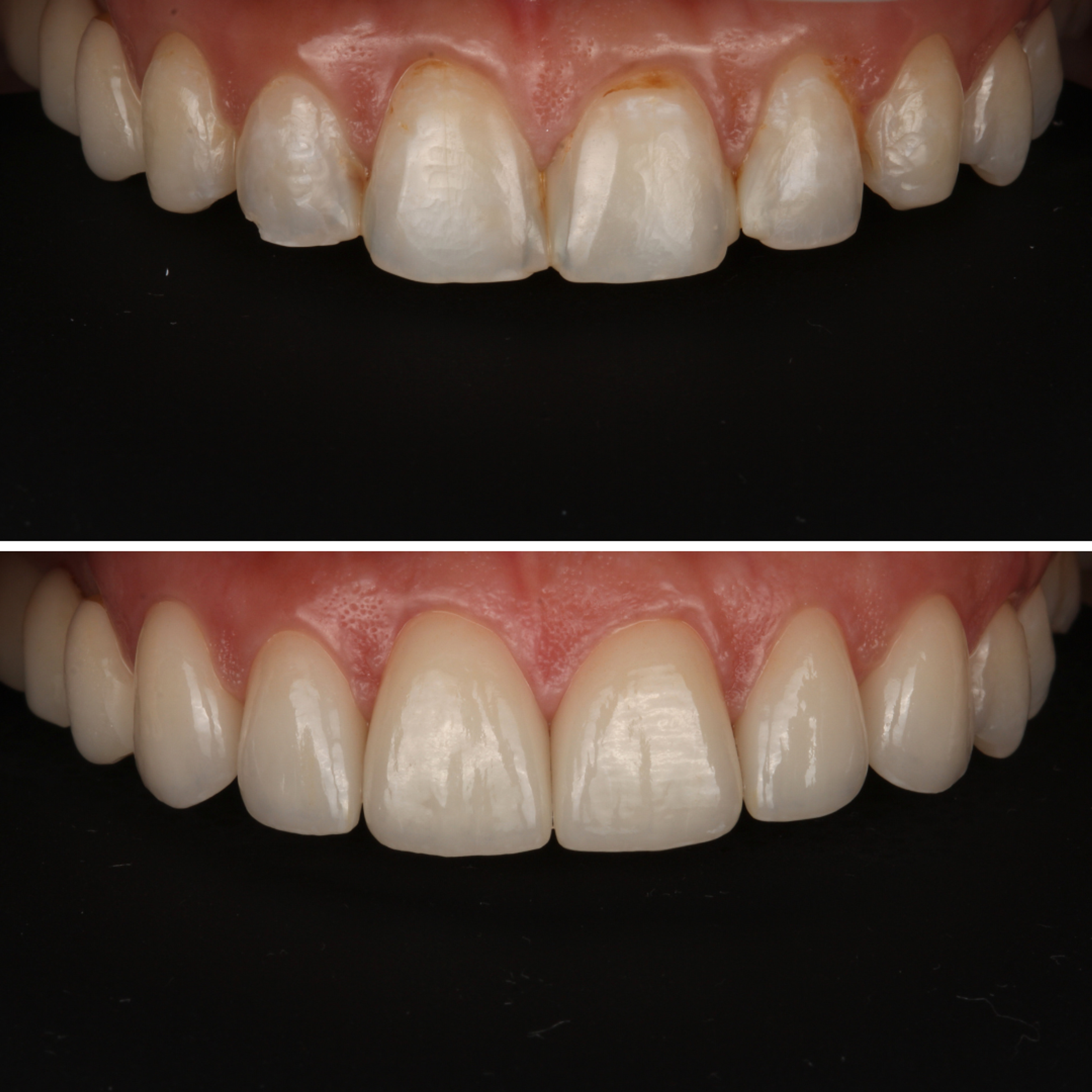 Porcelain Veneers — Clinical — before and after