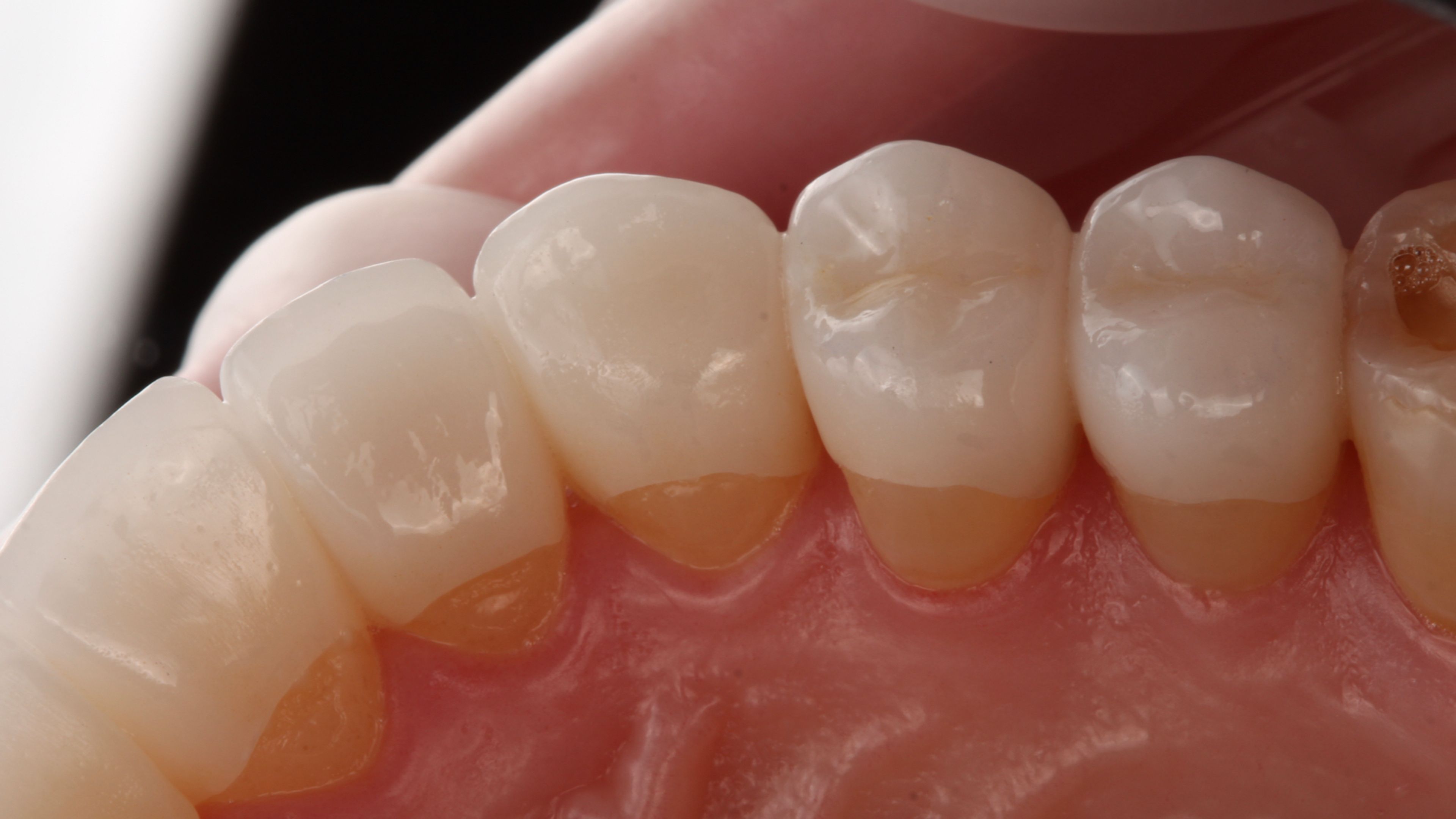 The same teeth restored with well-adapted porcelain — margins that meet the tooth seamlessly, with no gaps for plaque or bacteria to collect