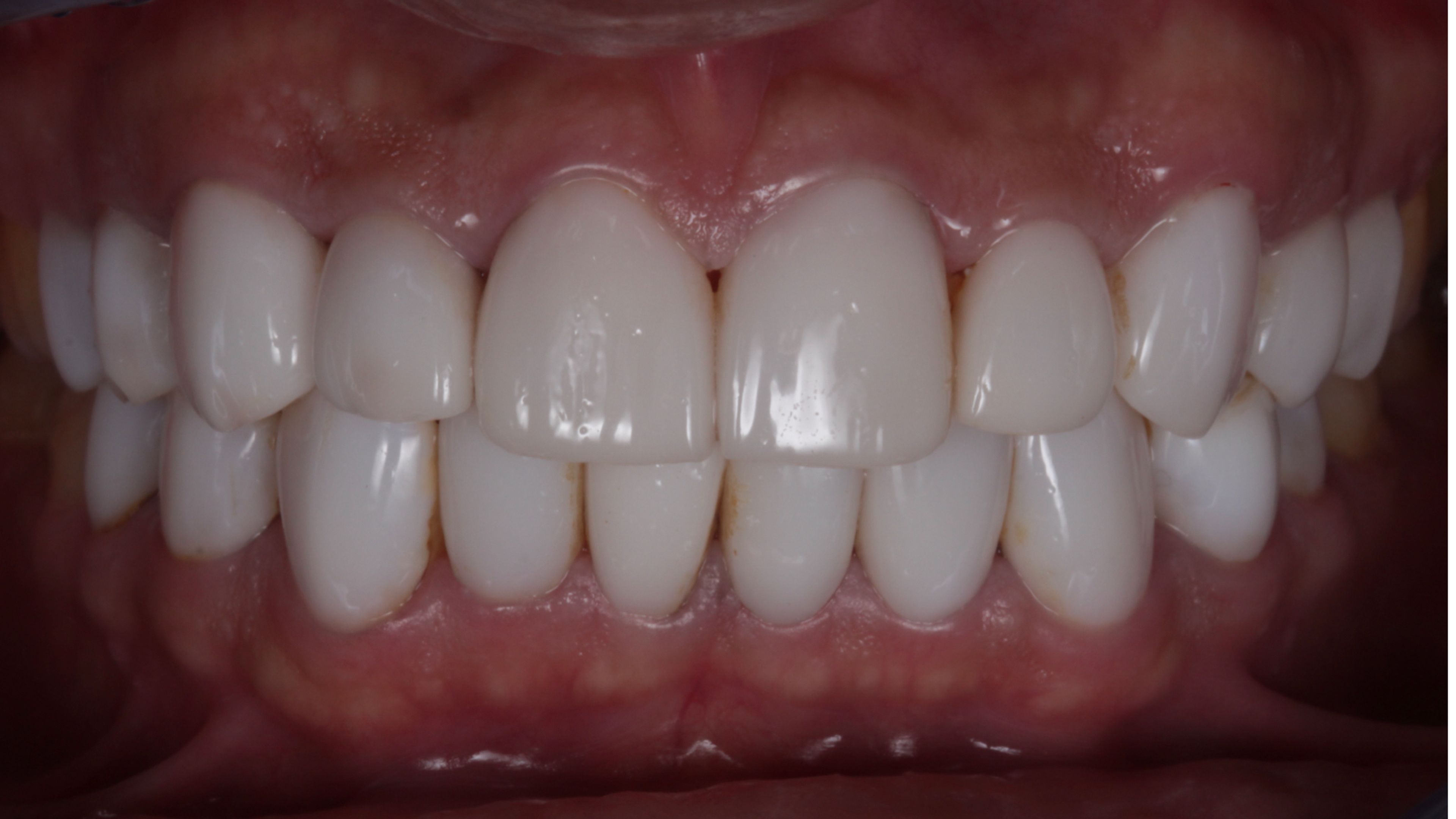 Close-up of the original twenty veneers showing the uniform shade and shape that made the smile look artificial