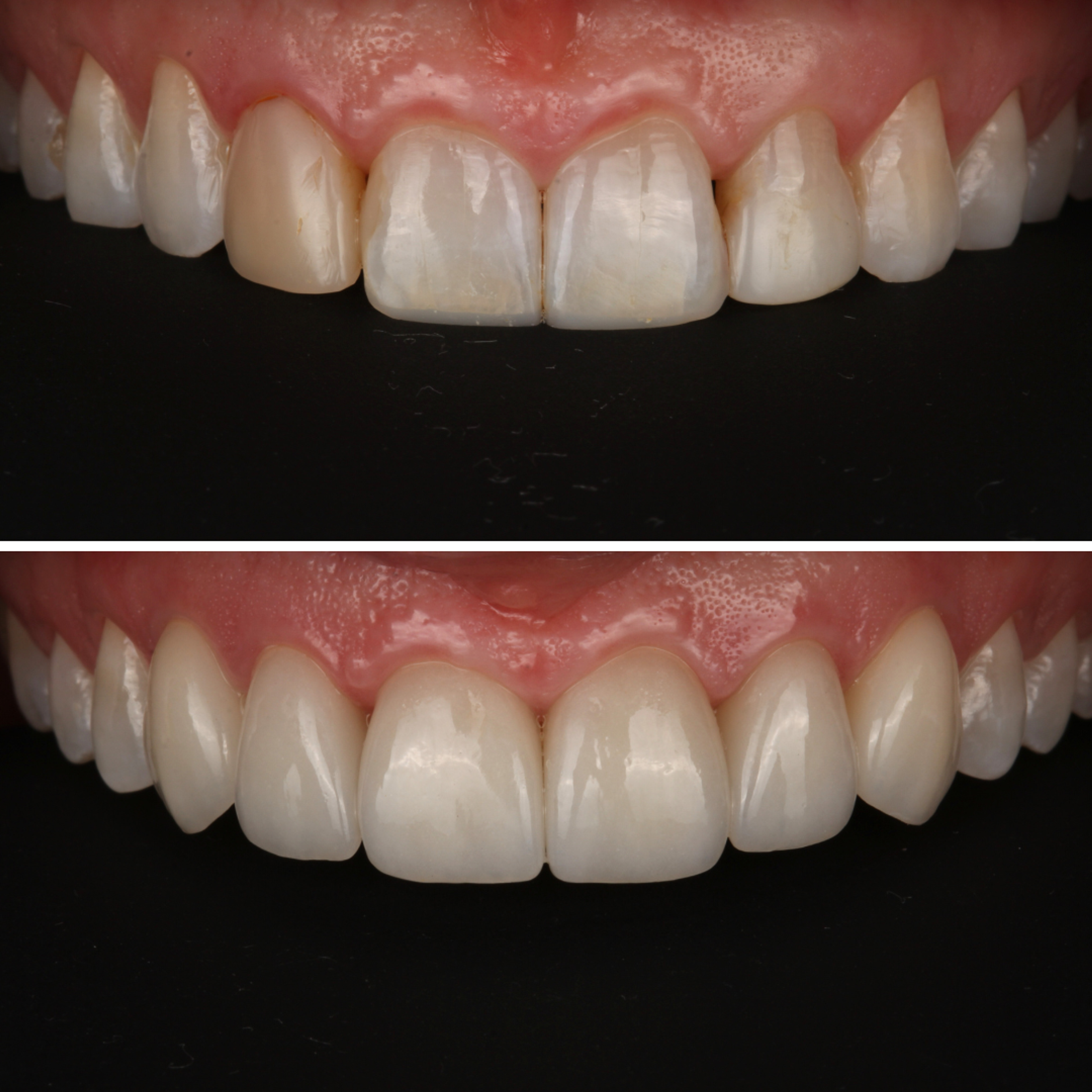 No-Prep Natural Veneers — before and after