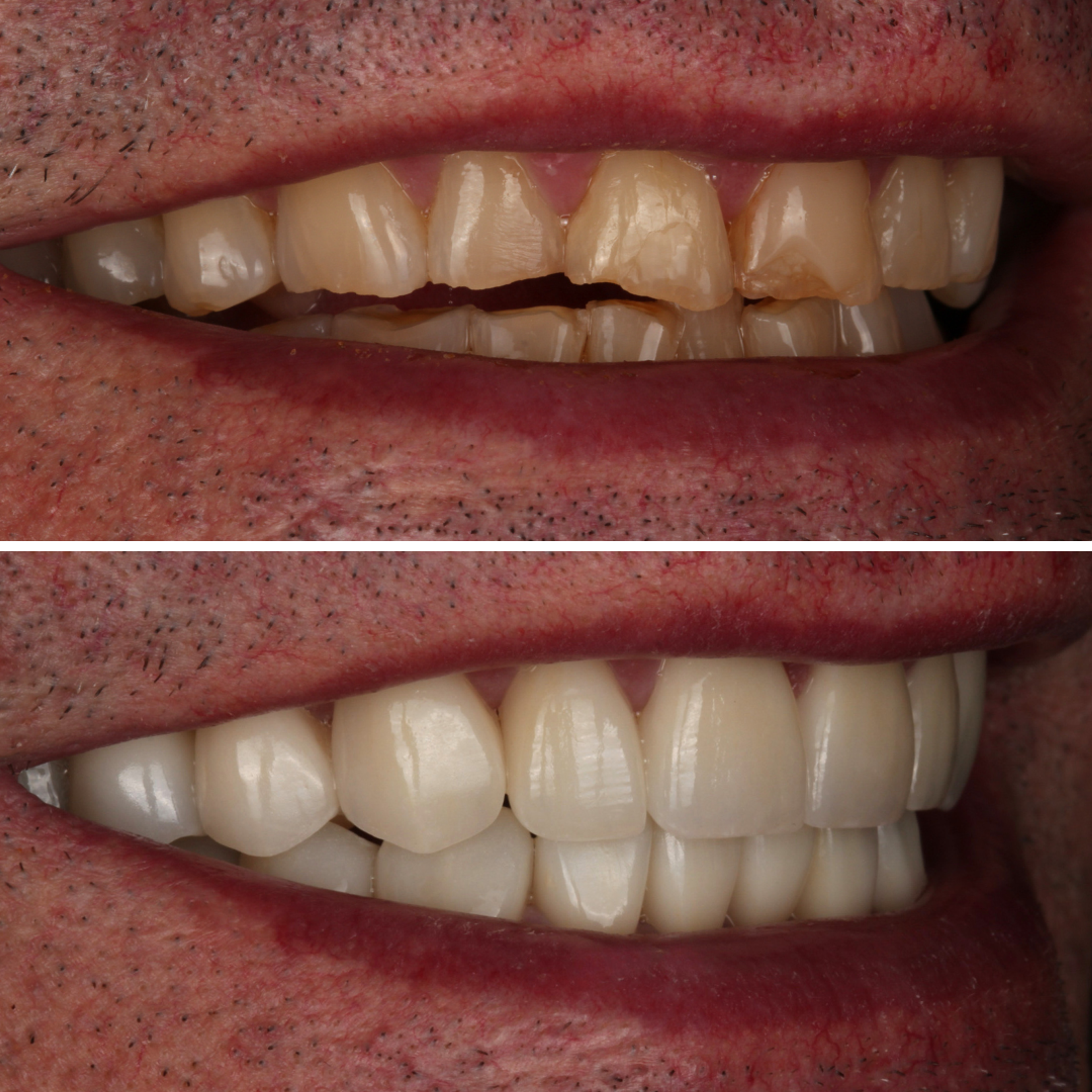 Full Mouth Reconstruction — before and after