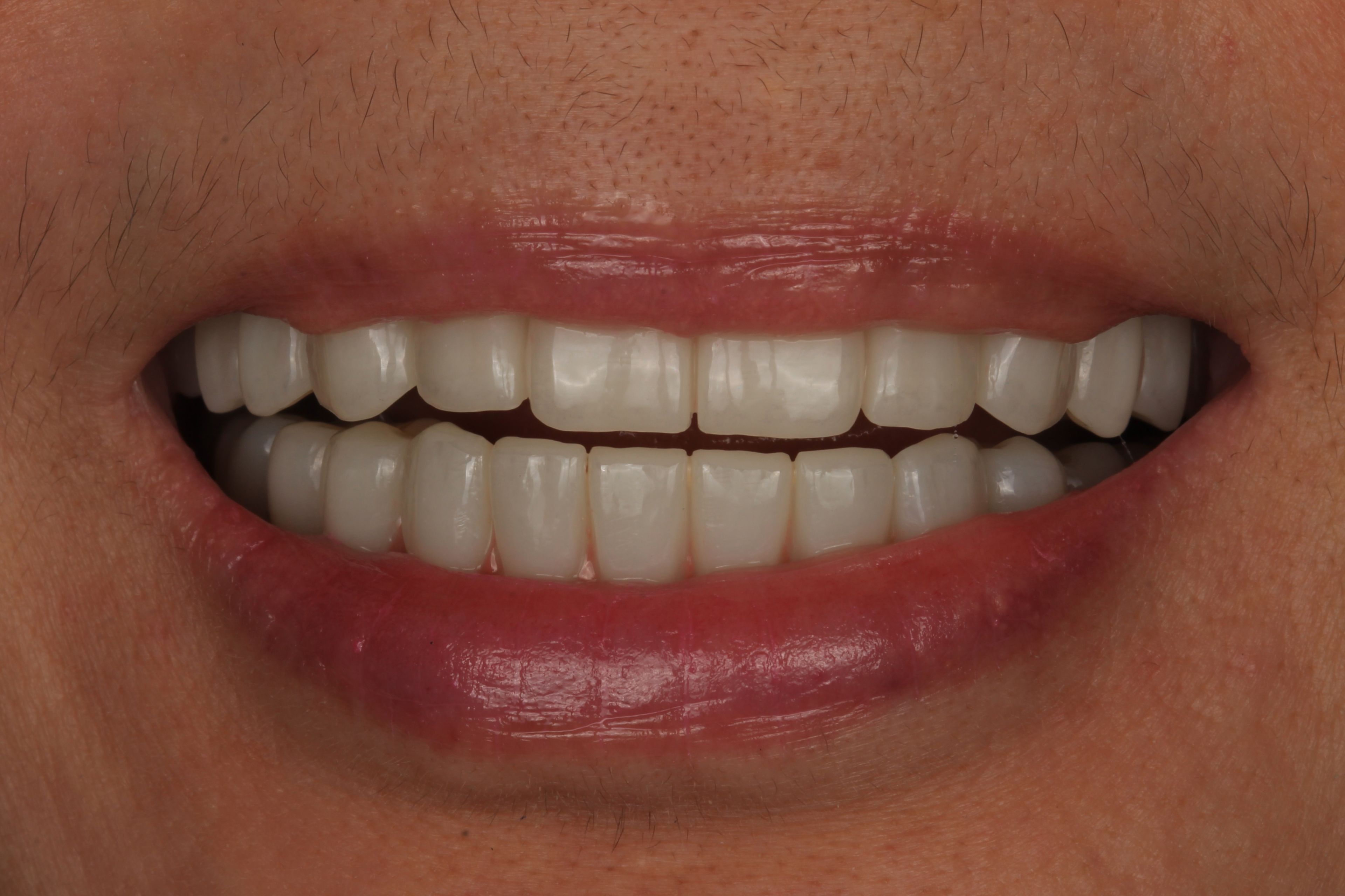 The final smile after the full-arch redo — a natural-looking implant-supported smile crafted by the in-house lab at Transcend