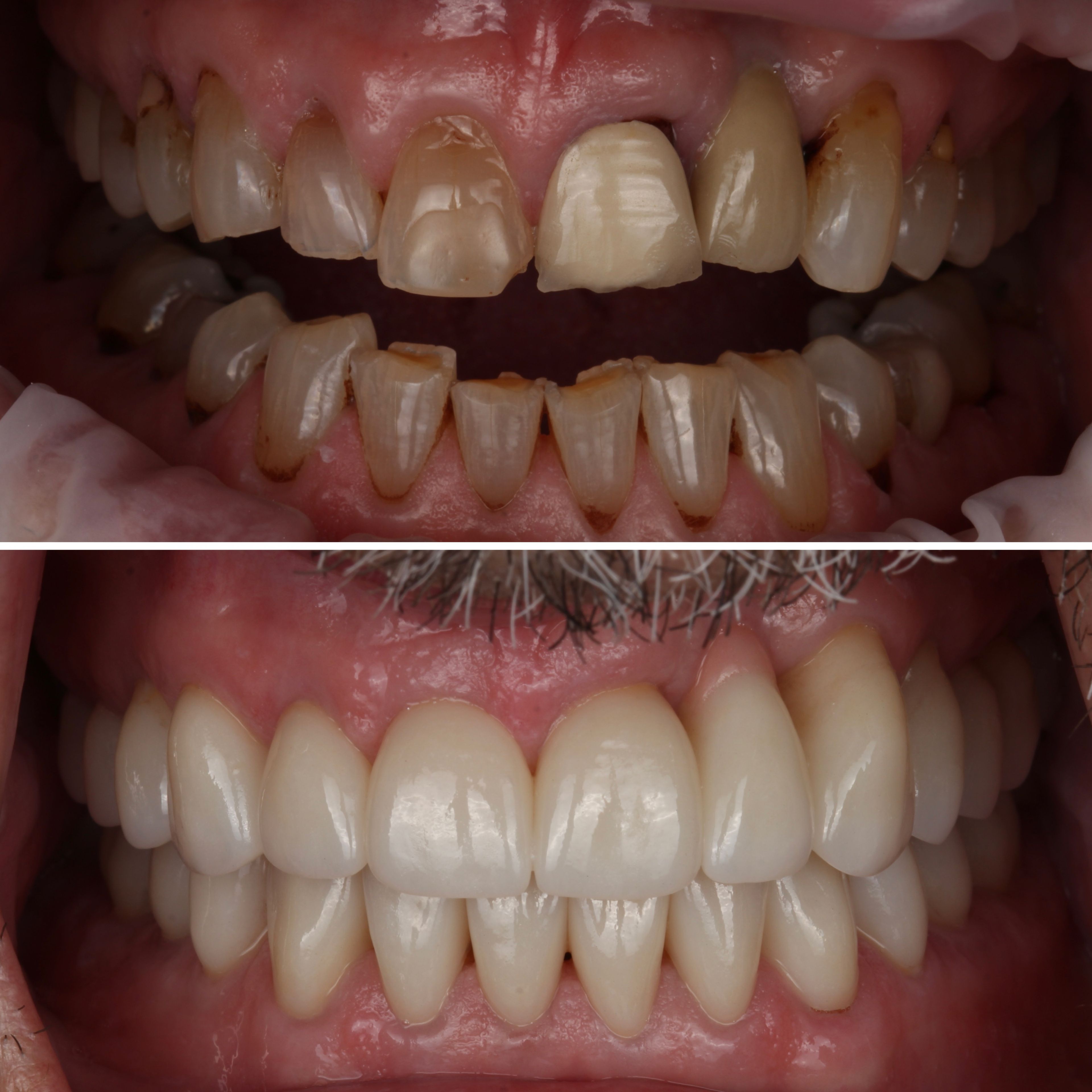 Full Mouth Reconstruction before and after - prosthodontist Vancouver - Transcend Dentistry