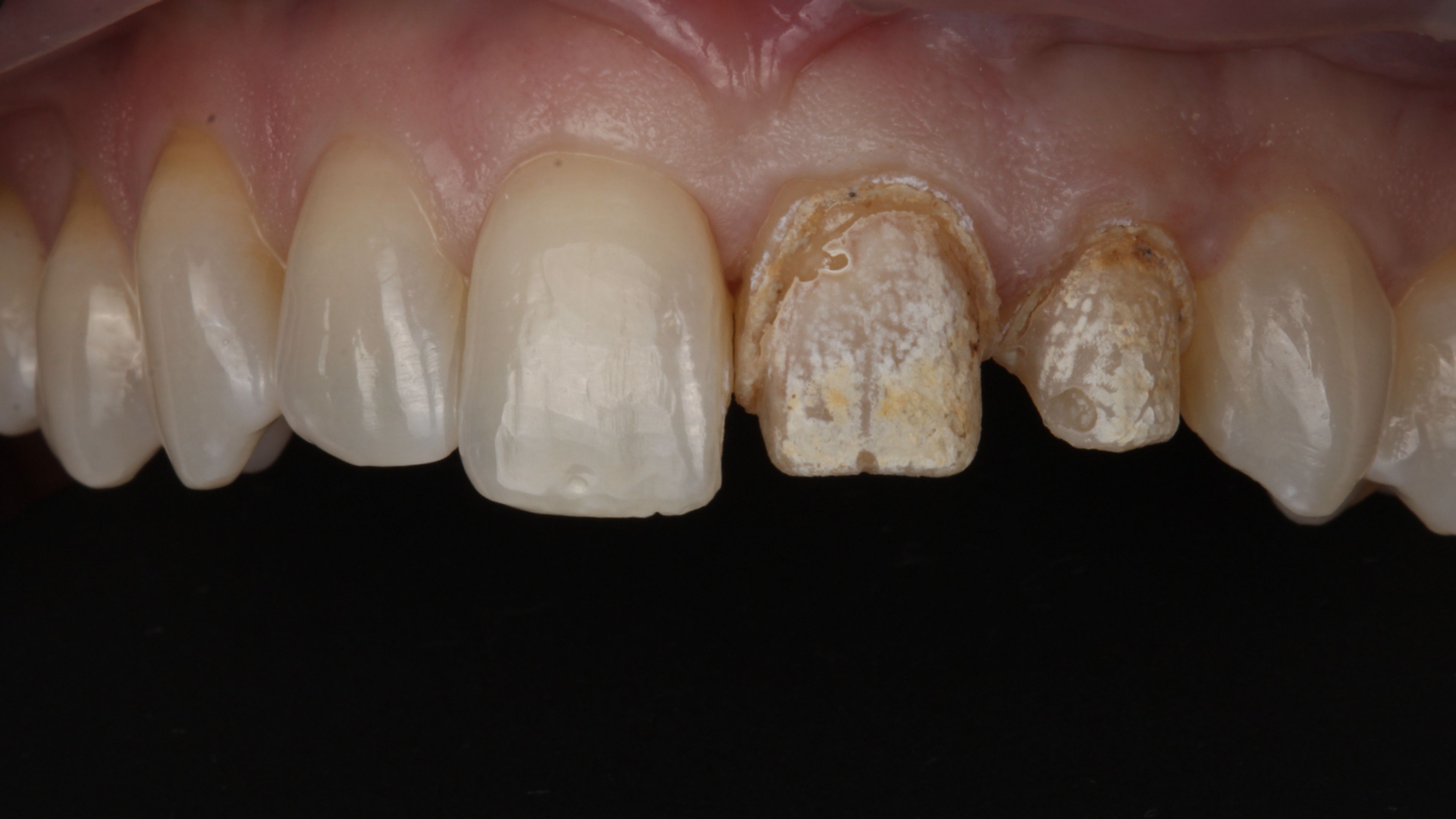 The same teeth immediately after the veneers were removed with an erbium laser — the underlying tooth structure is intact and undamaged, ready for the new restorations