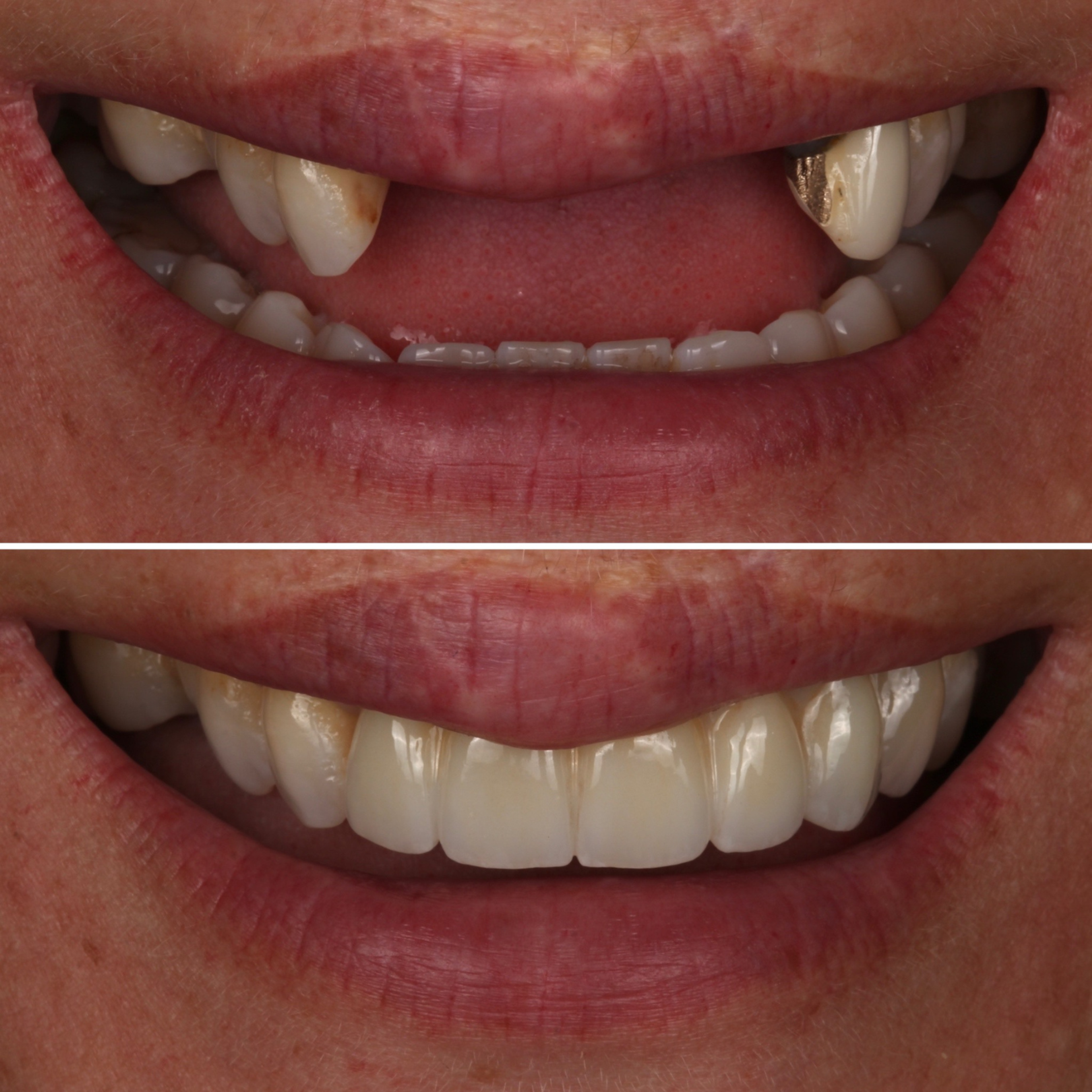 Anterior Implant — Smile Restored before and after - dental implants Vancouver - Transcend Dentistry