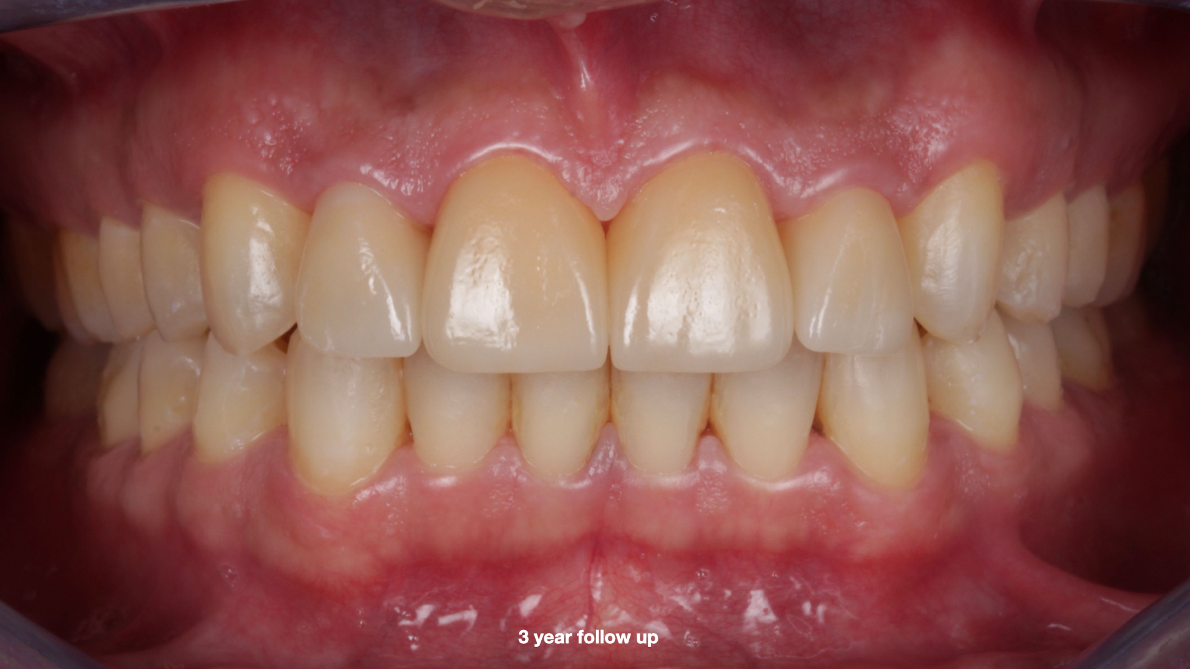Close-up of the final result — four porcelain veneers blended seamlessly with the patient's surrounding natural teeth, restoring a natural, individualized smile