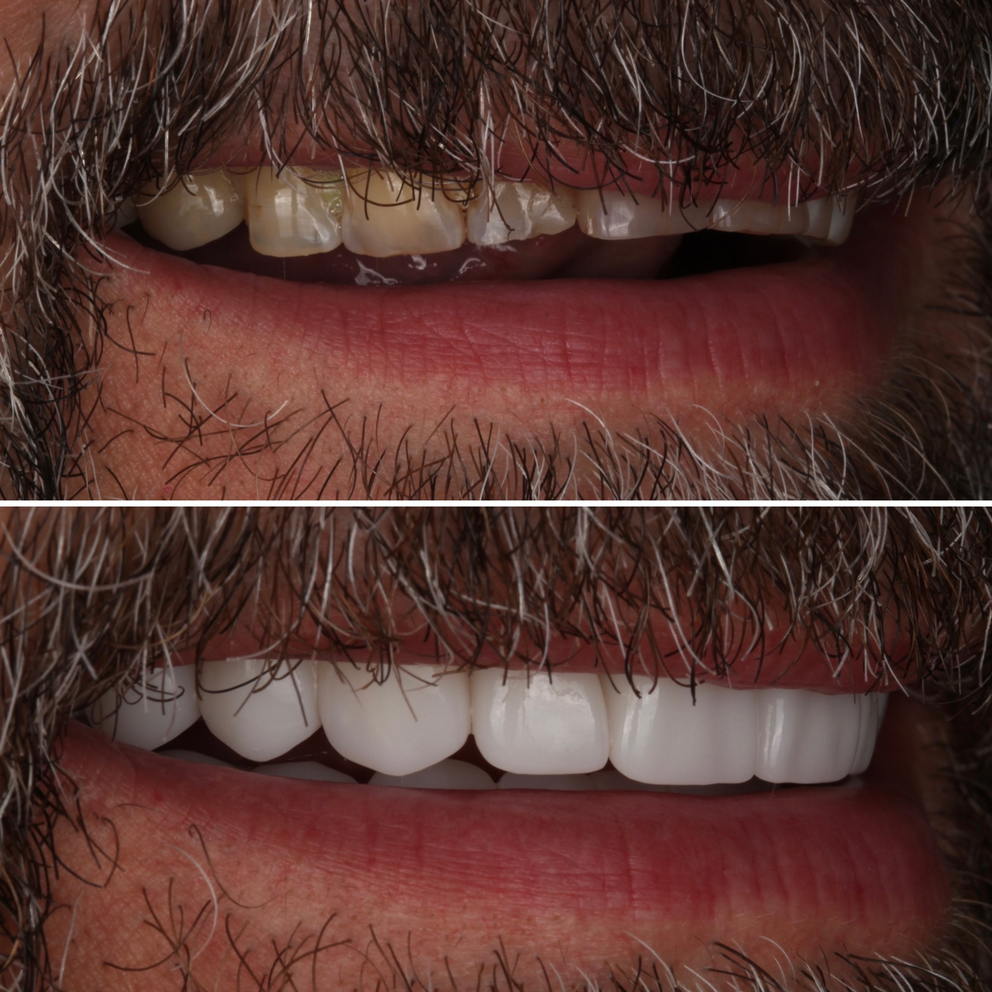 Full Mouth Reconstruction — Male before and after - prosthodontist Vancouver - Transcend Dentistry