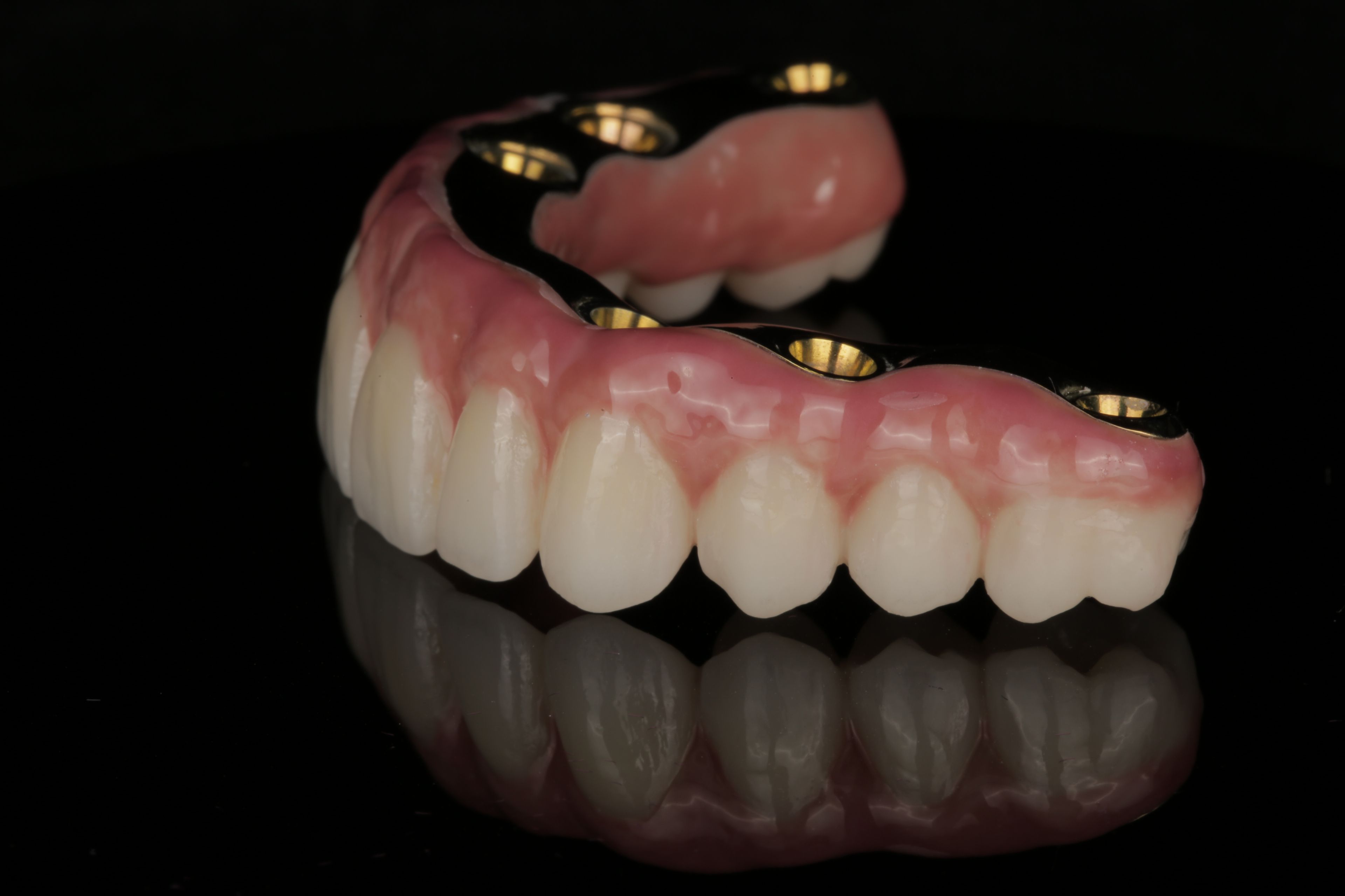 Full arch dental prosthesis crafted by the in-house lab