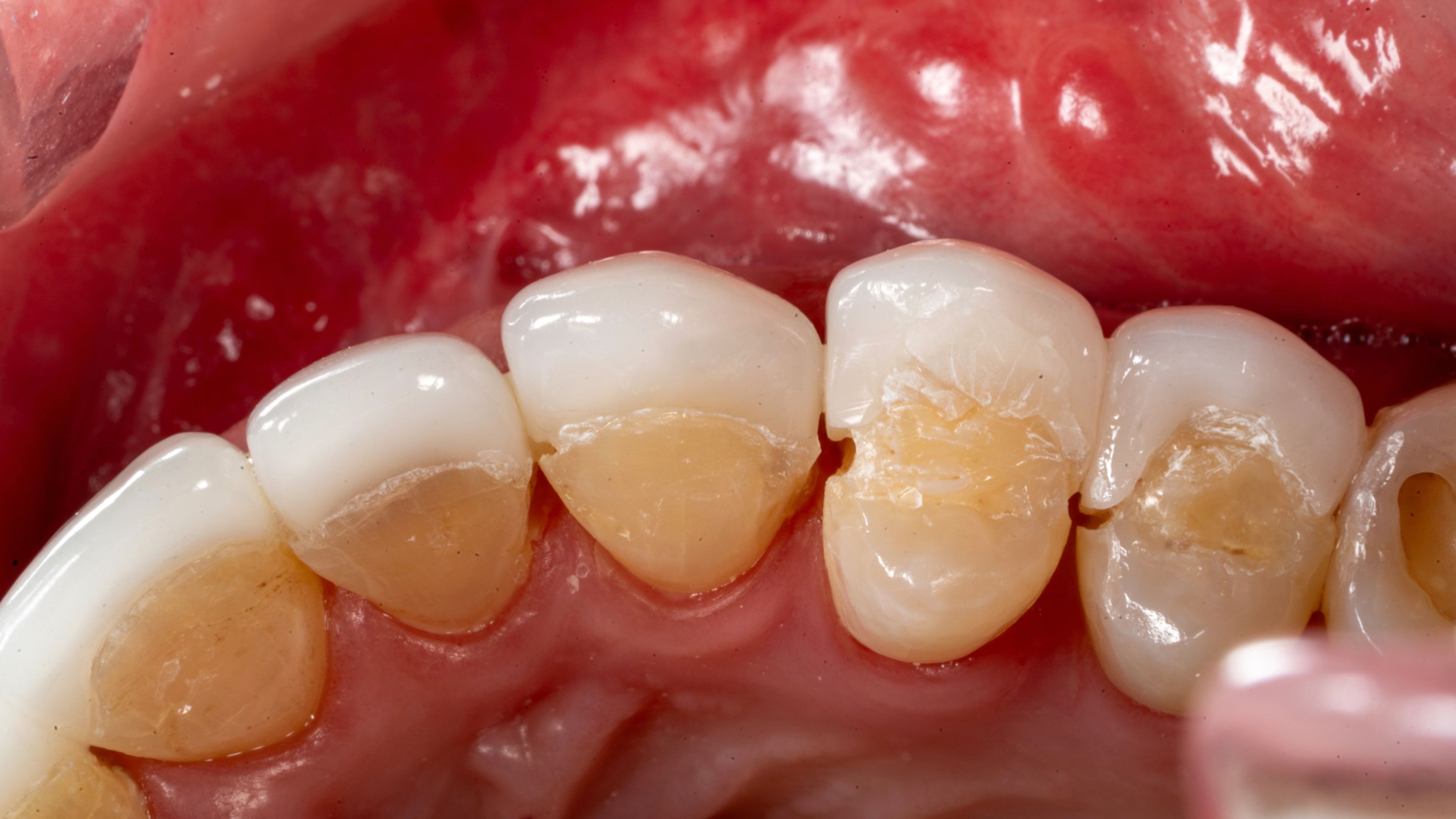 Poorly fitting porcelain restorations with visible gaps between the porcelain and the underlying tooth — gaps that can lead to chronic gum inflammation and recurrent cavities under the restoration