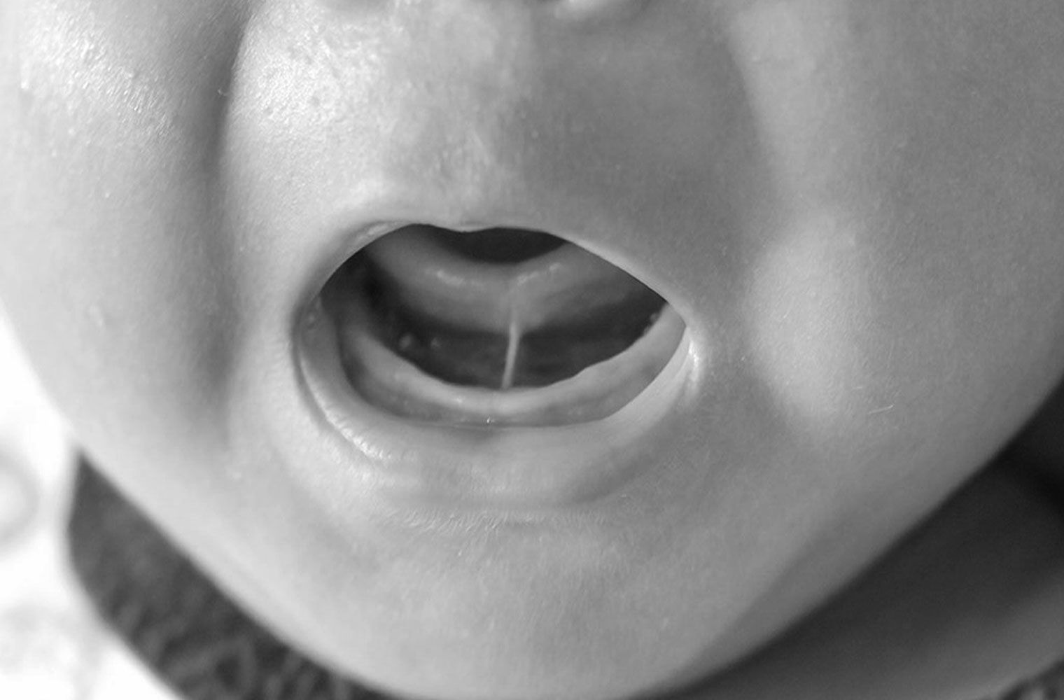 How Infant Tongue Tie Became the Most Controversial Breastfeeding