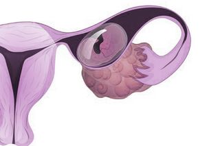 what is ectopic pregnancy