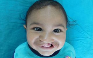 cleft lip and cleft palate