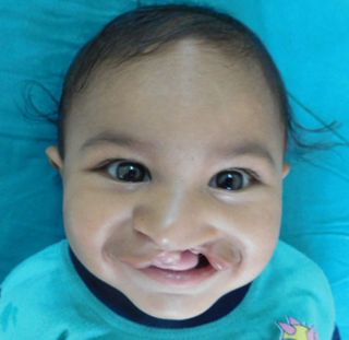 cleft lip and cleft palate