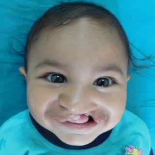 cleft lip and cleft palate