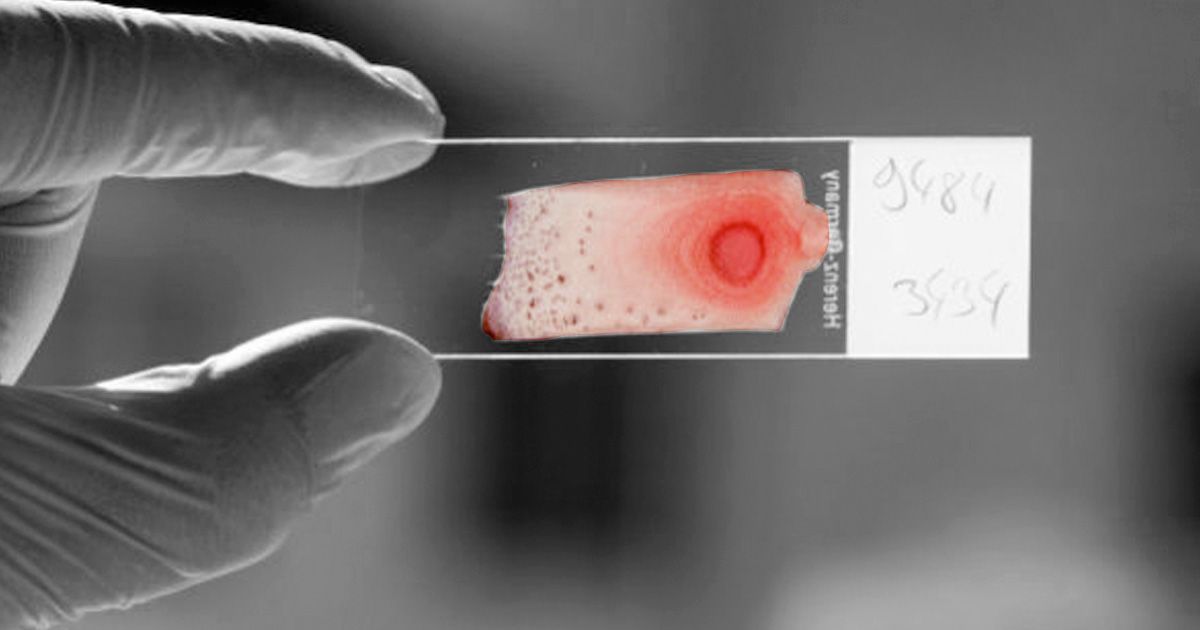 blood test for cancer