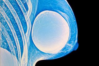 breast implant illness
