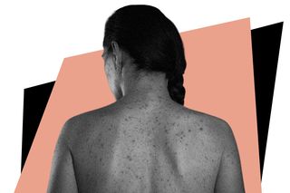 psoriasis autoimmune condition
