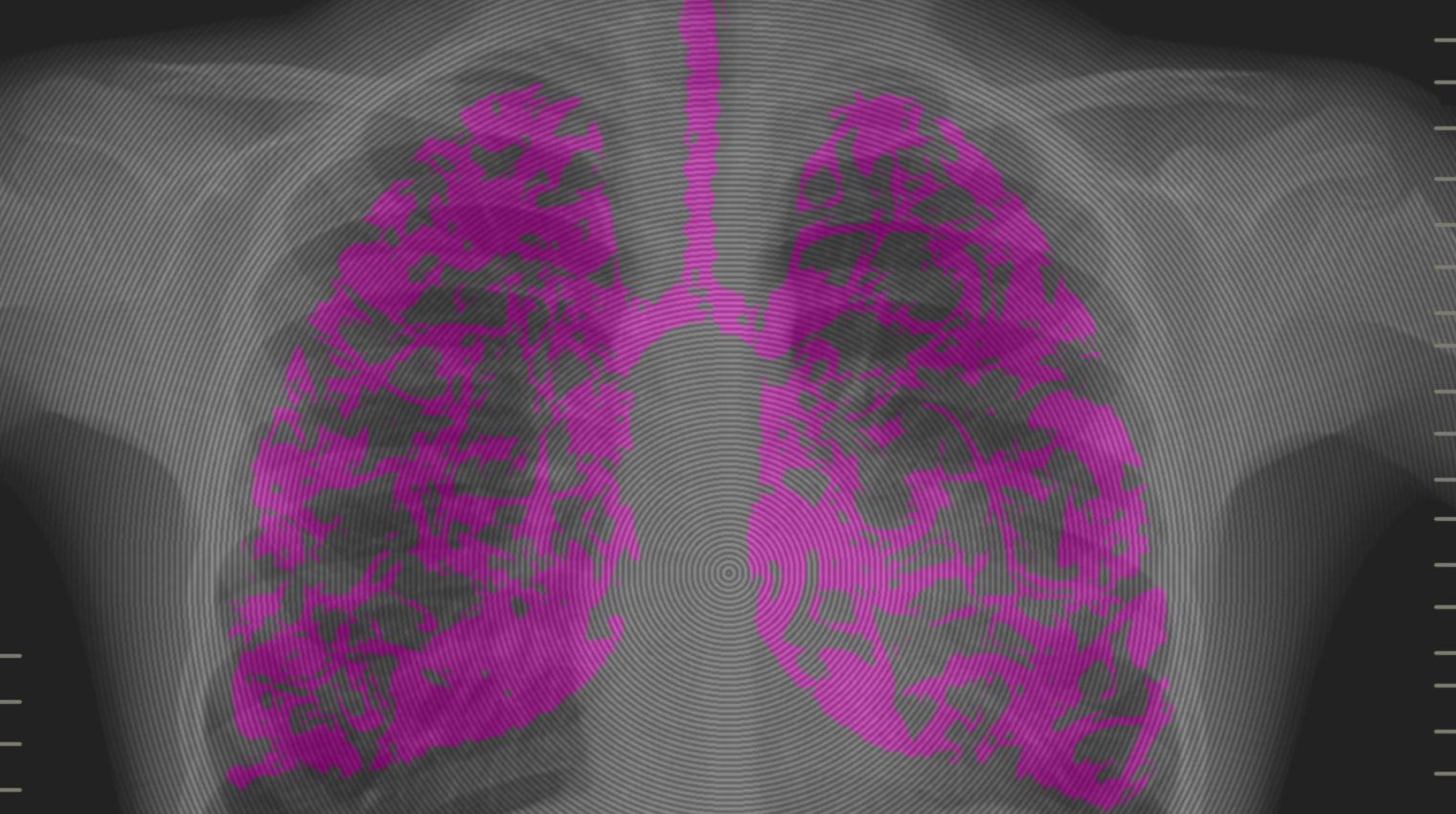difference between viral and bacterial pneumonia