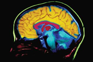 women Alzheimers risk