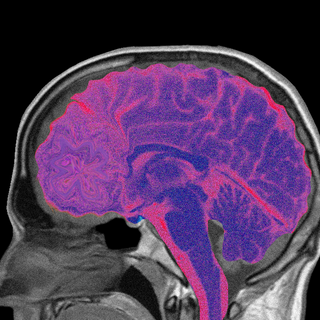 effects of depression on the brain