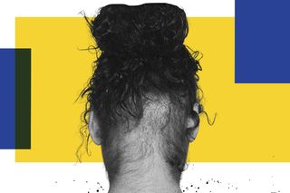 what causes alopecia
