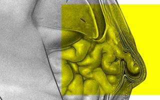 what causes a hernia