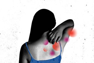 what is vasculitis