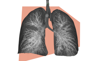 lung cancer diagnosis