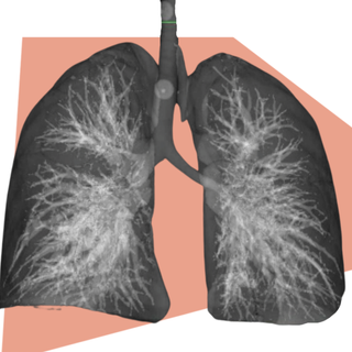 lung cancer diagnosis