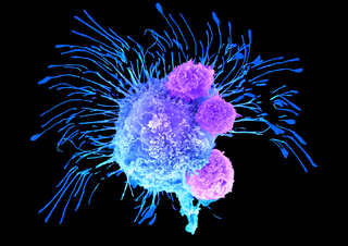 3D Printing Breast Cancer Tumors