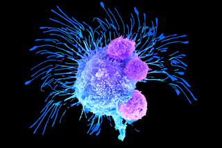 3D Printing Breast Cancer Tumors